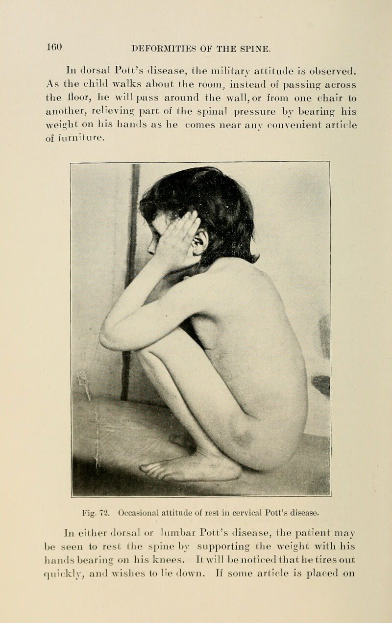 In dorsal Pott's disease, the military attitude is observed. As the child walks about the room^ instead of passing across the floor, he will pass around the wall, or from one chair to another, relieving jDart of the spinal pressure by bearing his weight on his hands as he comes near any convenient article of furniture. Fig. 72. Occasional attitude of rest in cervical Pott's disease. In either dorsal or liimljar Pott's disease, Ihe patient may be seen to rest tlie spine ))y supporting the Aveight with his liands bearing on his kjiees. It will be noticed tliat he tires out quickly, ami wislies to lie dowji. If sojne article is placed on