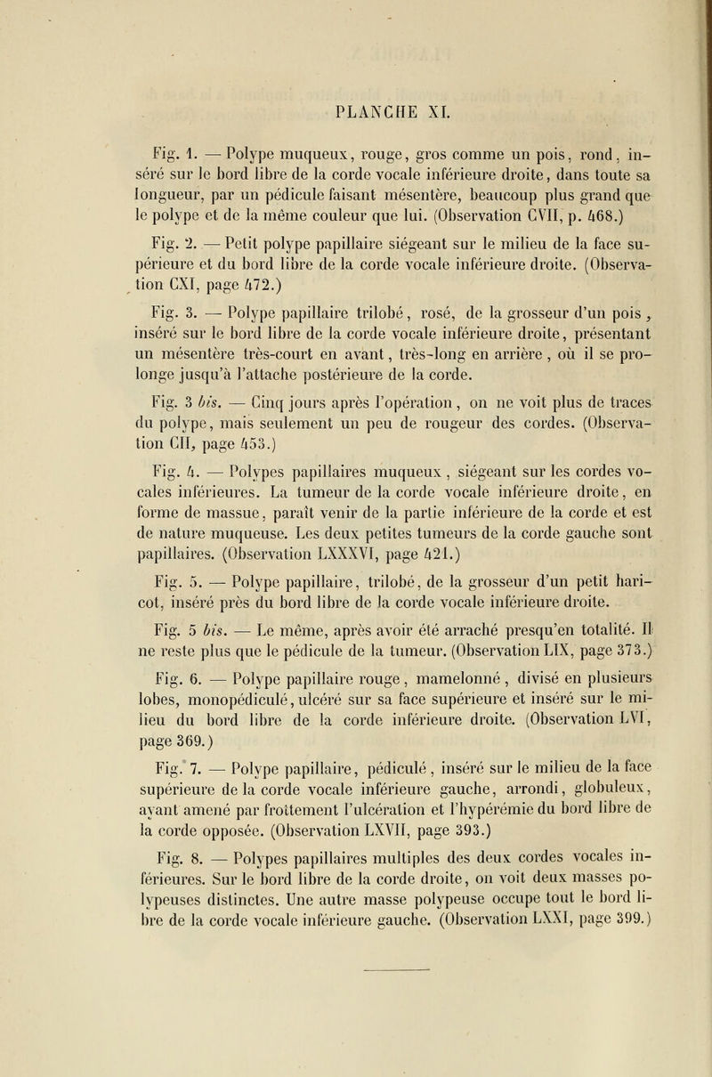 Fig. 1. —Polype muqueux, rouge, gros comme un pois, rond, in- séré sur le bord libre de la corde vocale inférieure droite, dans toute sa longueur, par un pédicule faisant mésentère, beaucoup plus grand que le polype et de la même couleur que lui. (Observation GVII, p. 468.) Fig. 2,.— Petit polype papillaire siégeant sur le milieu de la face su- périeure et du bord libre de la corde vocale inférieure droite. (Observa- tion CXI, page 472.) Fig. 3. — Polype papillaire trilobé, rosé, de la grosseur d'un pois ,. inséré sur le bord libre de la corde vocale inférieure droite, présentant un mésentère très-court en avant, très-long en arrière , où il se pro- longe jusqu'à l'attacbe postérieure de la corde. Fig. 3 bis. — Cinq jours après l'opération, on ne voit plus de traces du polype, mais seulement un peu de rougeur des cordes. (Observa- tion CIL page 453.) Fig. 4. — Polypes papillaires muqueux , siégeant sur les cordes vo- cales inférieures. La tumeur de la corde vocale inférieure droite, en forme de massue, paraît venir de la partie inférieure de la corde et est de nature muqueuse. Les deux petites tumeurs de la corde gauche sont papillaires. (Observation LXXXVI, page 421.) Fig. 5. — Polype papillaire, trilobé, de la grosseur d'un petit hari- cot, inséré près du bord libre de la corde vocale inférieure droite. Fig. 5 bis. — Le même, après avoir été arraché presqu'en totalité. IL ne reste plus que le pédicule de la tumeur. (Observation LIX, page 373.) Fig. 6. — Polype papillaire rouge , mamelonné , divisé en plusieurs lobes, monopédiculé, ulcéré sur sa face supérieure et inséré sur le mi- lieu du bord libre de la corde inférieure droite. (Observation LVI, page 369.) Fig. 7. — Polype papillaire, pédicule , inséré sur le milieu de la face supérieure de la corde vocale inférieure gauche, arrondi, globuleux, ayant amené par frottement l'ulcération et l'hypérémie du bord libre de la corde opposée. (Observation LXVII, page 393.) Fig. 8. — Polypes papillaires multiples des deux cordes vocales in- férieures. Sur le bord libre de la corde droite, on voit deux masses po- lypeuses distinctes. Une autre masse polypeuse occupe tout le bord li- bre de la corde vocale inférieure gauche. (Observation LXXI, page 399.)