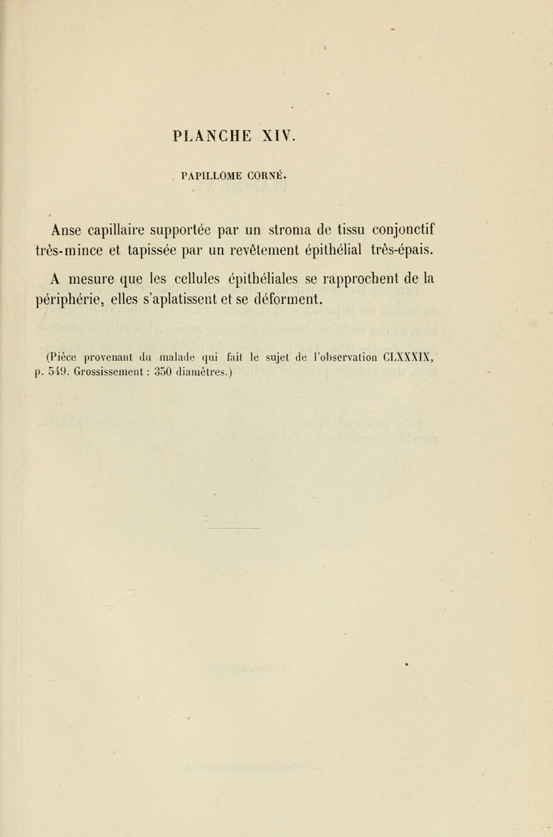 PAPILLOME CORNÉ. Anse capillaire supportée par un stroma de tissu conjonctif très-mince et tapissée par un revêtement épithélial très-épais. A mesure que les cellules épithéliales se rapprochent de la périphérie, elles s'aplatissent et se déforment. (Pièce provenant du malade qui fait le sujet de l'observation CLXXXIX,