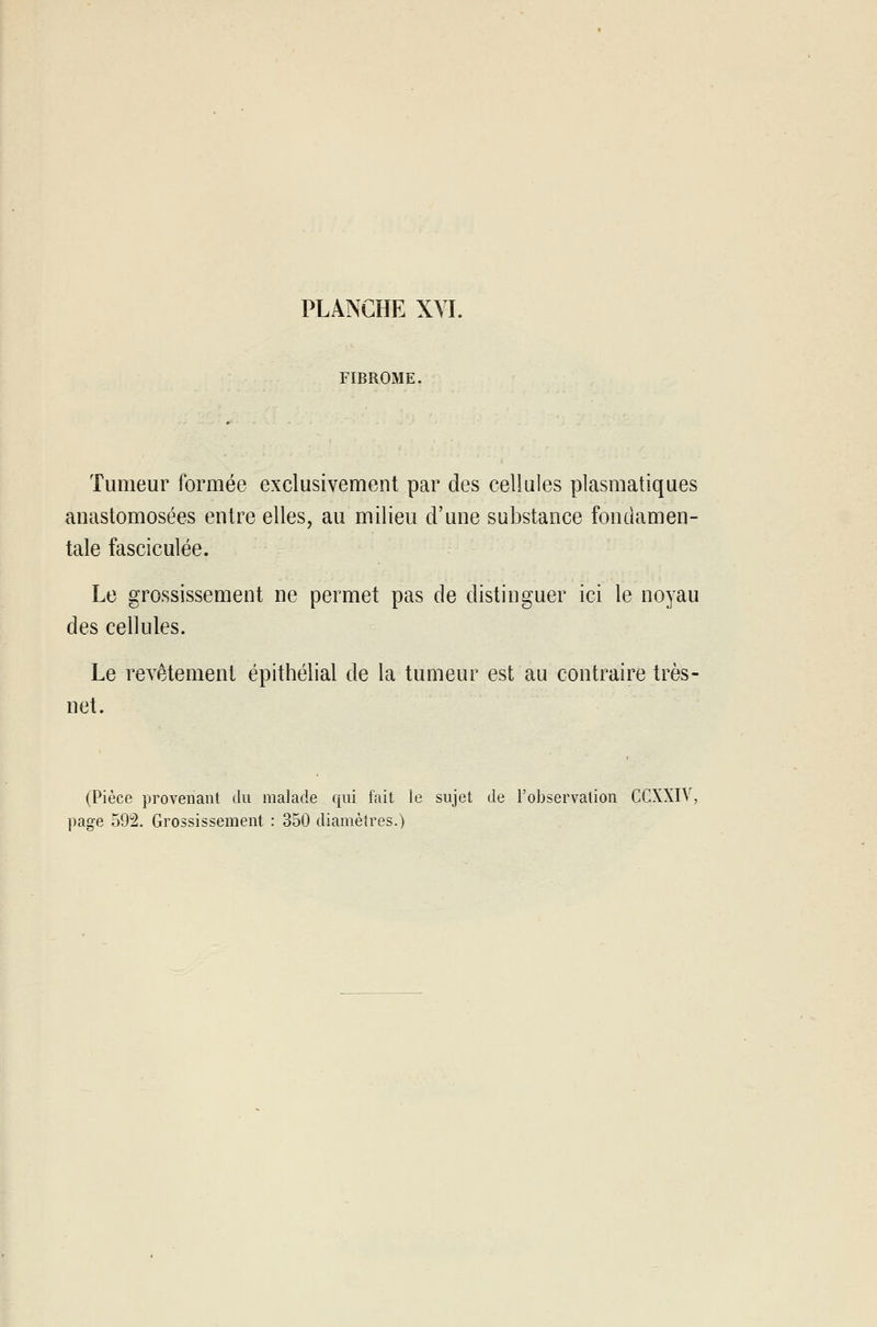 FIBROME. Tumeur formée exclusivement par des cellules plasmatiques anastomosées entre elles, au milieu d'une substance fondamen- tale fasciculée. Le grossissement ne permet pas de distinguer ici le noyau des cellules. Le revêtement épithélial de la tumeur est au contraire très- net. (Pièce provenant du malade qui fait le sujet de l'observation CCXXIV,