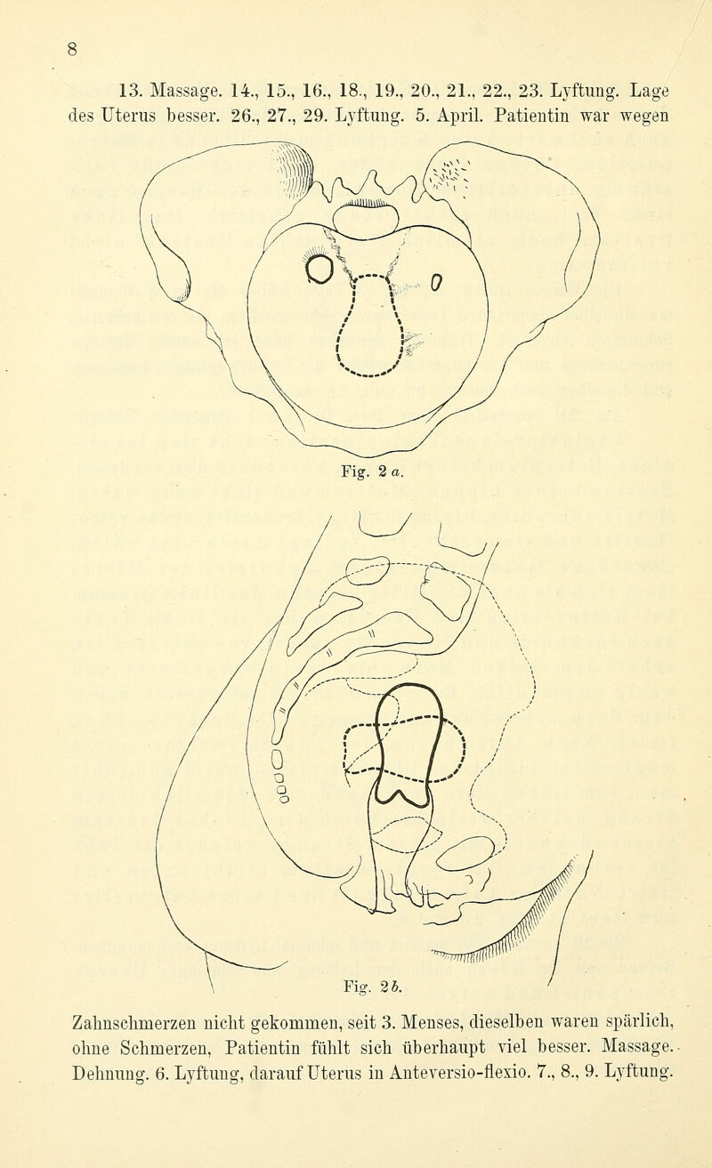 13. Massage. 14., 15., 16., 18., 19., 20., 21., 22., 23. Lyftung. Lage des Uterus besser. 26., 27., 29. Lyftung. 5. April. Patientin war wegen Fig. 2 a. Fi?. 2b. Zahnschmerzen nicht gekommen, seit 3. Menses, dieselben waren spärlich, ohne Schmerzen, Patientin fühlt sich überhaupt viel besser. Massage.