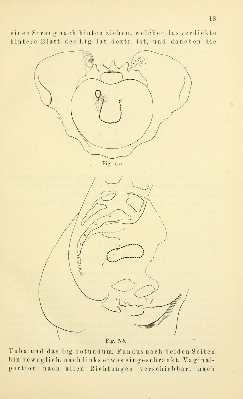 e i n e n S t r a n g n a c h h i 111 e 11 ziehen, welcher dasverdickte hintere Blatt des L i g. 1 a t. d e x t r. ist, und daneben die Fig. 5 a. Fig. 5 5. Tuba und das Lig. rotundum. Fundus nach beiden Seiten hin beweglich, nachlinks etwas eingeschränkt. Vaginal- portion nach allen Eichtun gen verschiebbar, nach