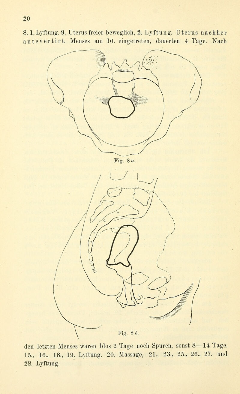 8. l.Lyftung. 9. Uterus freier beweglich, 2. Lyftung. Uterus nachher antevertirt. Menses am 10. eingetreten, dauerten 4 Tage. Nach Fig. 8 a. den letzten Menses waren blos 2 Tage noch Spuren, sonst 8—14 Tage. 15., 16., 18., 19. Lyftung. 20. Massage, 21., 23., 25., 26., 27. und 28. Lyftung.