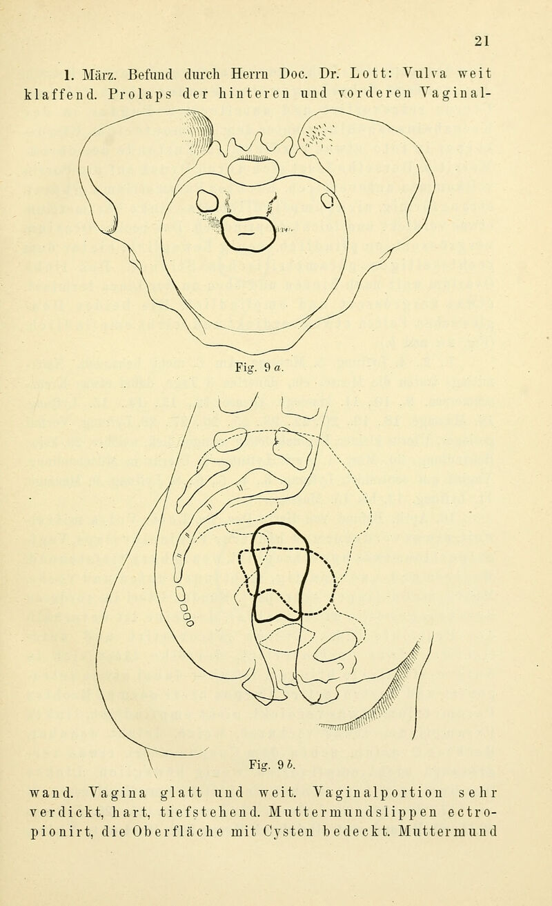 1. März. Befund durch Herrn Doc. Dr. Lott: Vulva weit klaffend. Prolaps der hinteren und vorderen Vaginal- Fi<?. 9 a. Fi?. 9 5. wand. Vagina glatt und weit. Vaginalportion sehr verdickt, hart, tiefstehend. Muttermundslippen ectro- pionirt, die Oberfläche mit Cysten bedeckt. Muttermund