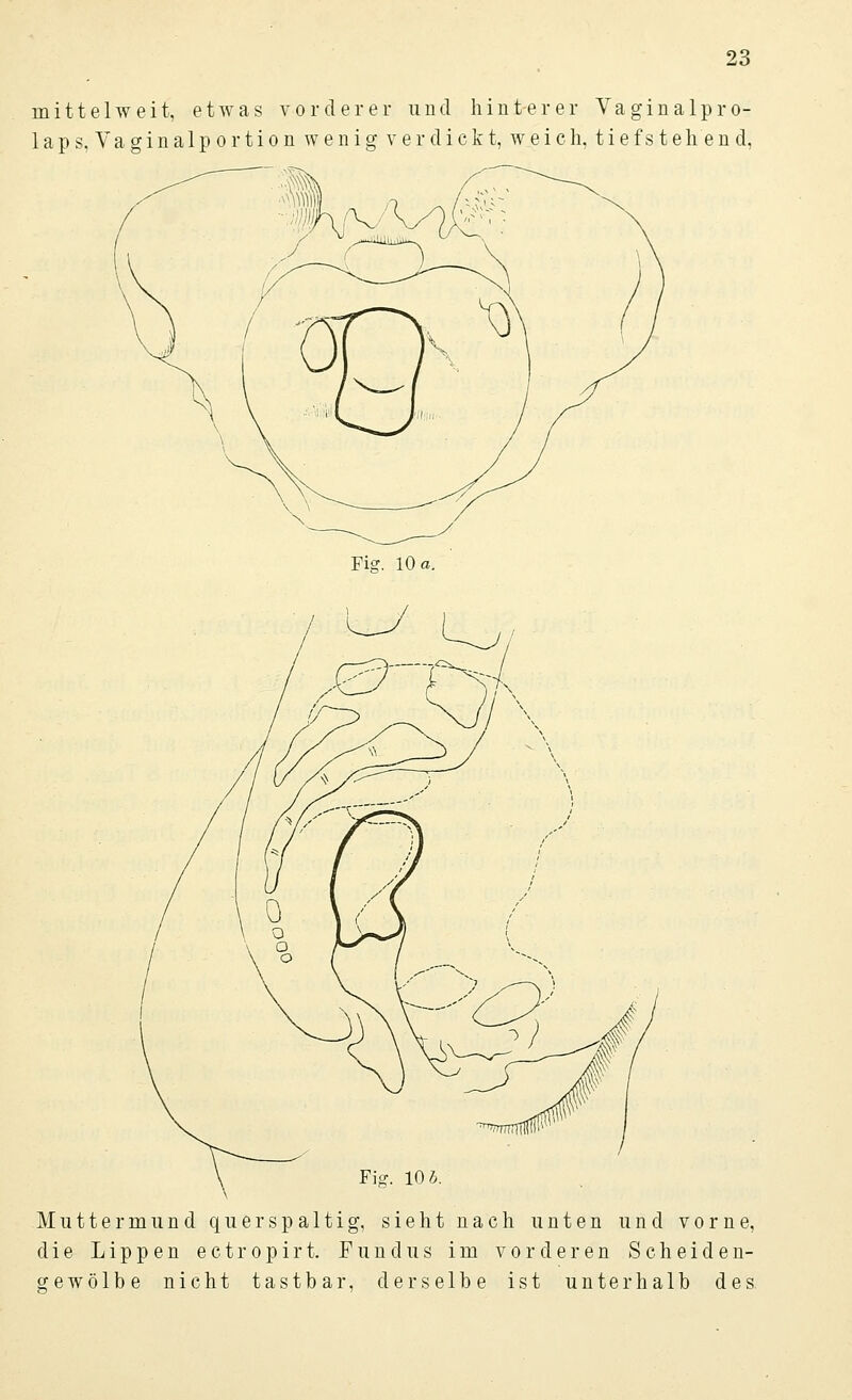 mittel weit, etwas vorderer und hinterer Vaginalpro- laps. Vaginalportion wenig verdickt, weich, tief st eh en d, Fig. 10 b. Muttermund querspaltig, sieht nach unten und vorne, die Lippen ectropirt. Fundus im vorderen Scheiden- gewölbe nicht tastbar, derselbe ist unterhalb des