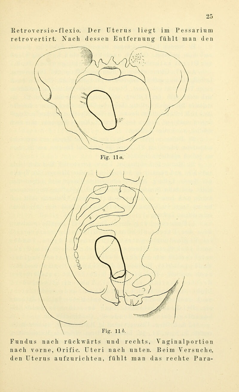 Retroversio-flexio. Der Uterus liegt im Pessarium retro vertirt. Nach dessen Entf er minor fühlt man den Fi*. IIb. Fundus nach rückwärts und rechts, Vaginalportion nach vorne, Orific. Uteri nach unten. Beim Versuche, den Uterus aufzurichten, fühlt man das rechte Para-