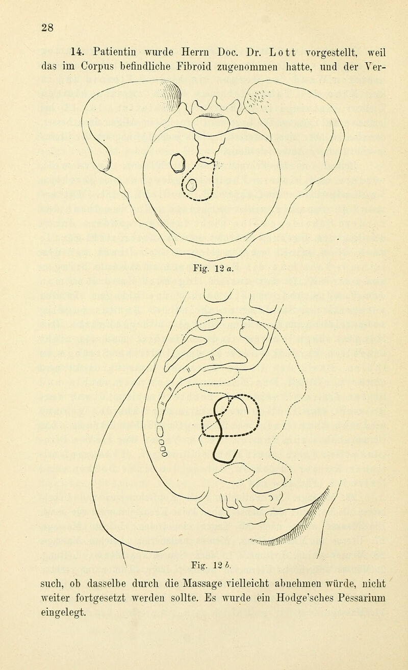 14. Patientin wurde Herrn Doc. Dr. Lott vorgestellt, weil das im Corpus befindliche Fibroid zugenommen hatte, und der Ver- Fig. 12 a. such, ob dasselbe durch die Massage vielleicht abnehmen würde, nicht weiter fortgesetzt werden sollte. Es wurde ein Hodge'sches Pessarium eingelegt.