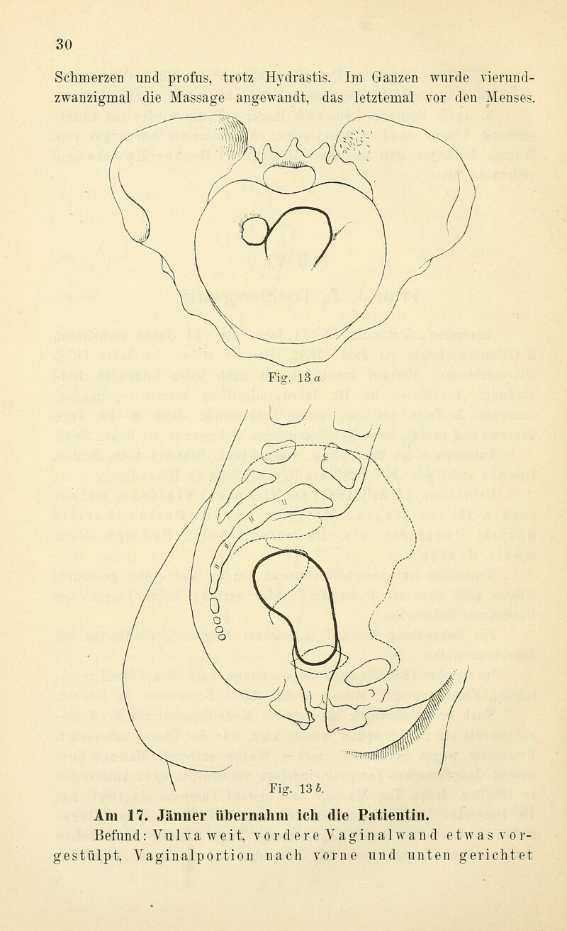 Schmerzen und profus, trotz Hydrastis. Im Ganzen wurde vierund- zwanzigmal die Massage angewandt, das letztemal vor den Menses. Fig. 13 a. Am 17. Jänner übernahm ich die Patientin. Befund: Vu 1 v a w e i t, vordereVaginalwand etwas vor- gestülpt, Vaginalportion nach vorne und unten gerichtet