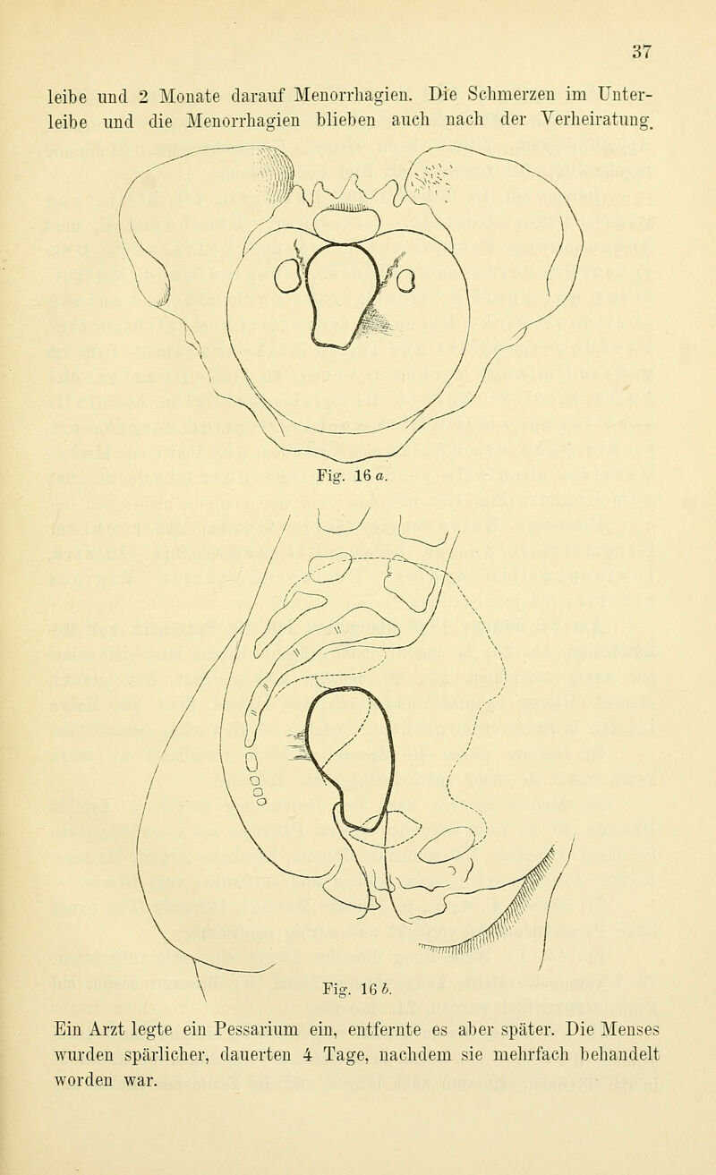 leibe und 2 Monate darauf Menorrhagien. Die Schmerzen im Unter- leibe und die Menorrhagien blieben auch nach der Verheiratung. Fig. 16 a. Fig. 16i. Ein Arzt legte ein Pessarium ein, entfernte es aber später. Die Menses wurden spärlicher, dauerten 4 Tage, nachdem sie mehrfach behandelt worden war.