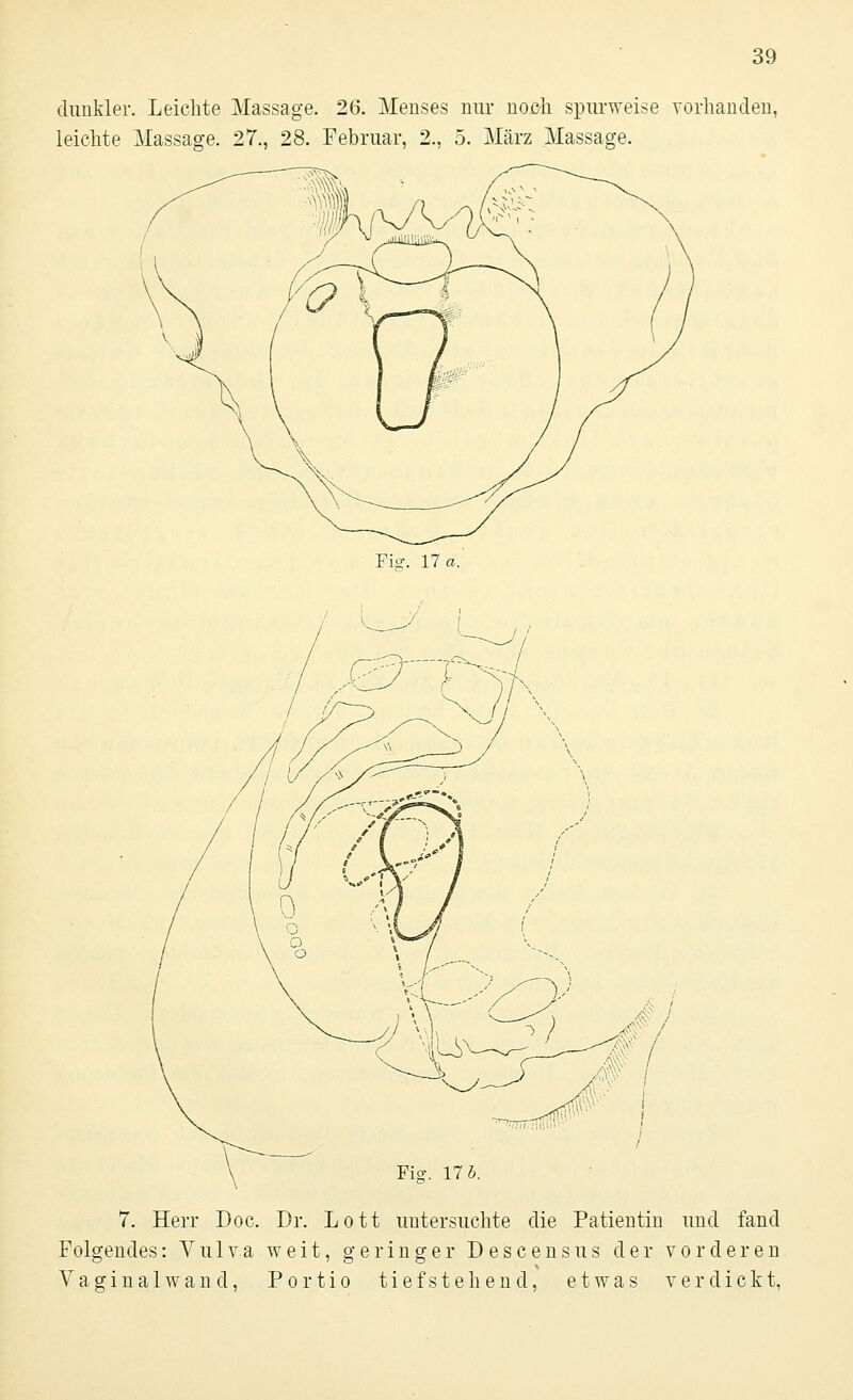 dunkler. Leichte Massage. 26. Menses nur noch spurweise vorhanden, leichte Massage. 27., 28. Februar, 2., 5. März Massage. Fisr. 17«. Fig. 17 5. 7. Herr Doc. Dr. Lott untersuchte die Patientin und fand Folgendes: Vulva weit, geringer Descensus der vorderen Vaginalwand, Portio tief stehend, etwas verdickt,