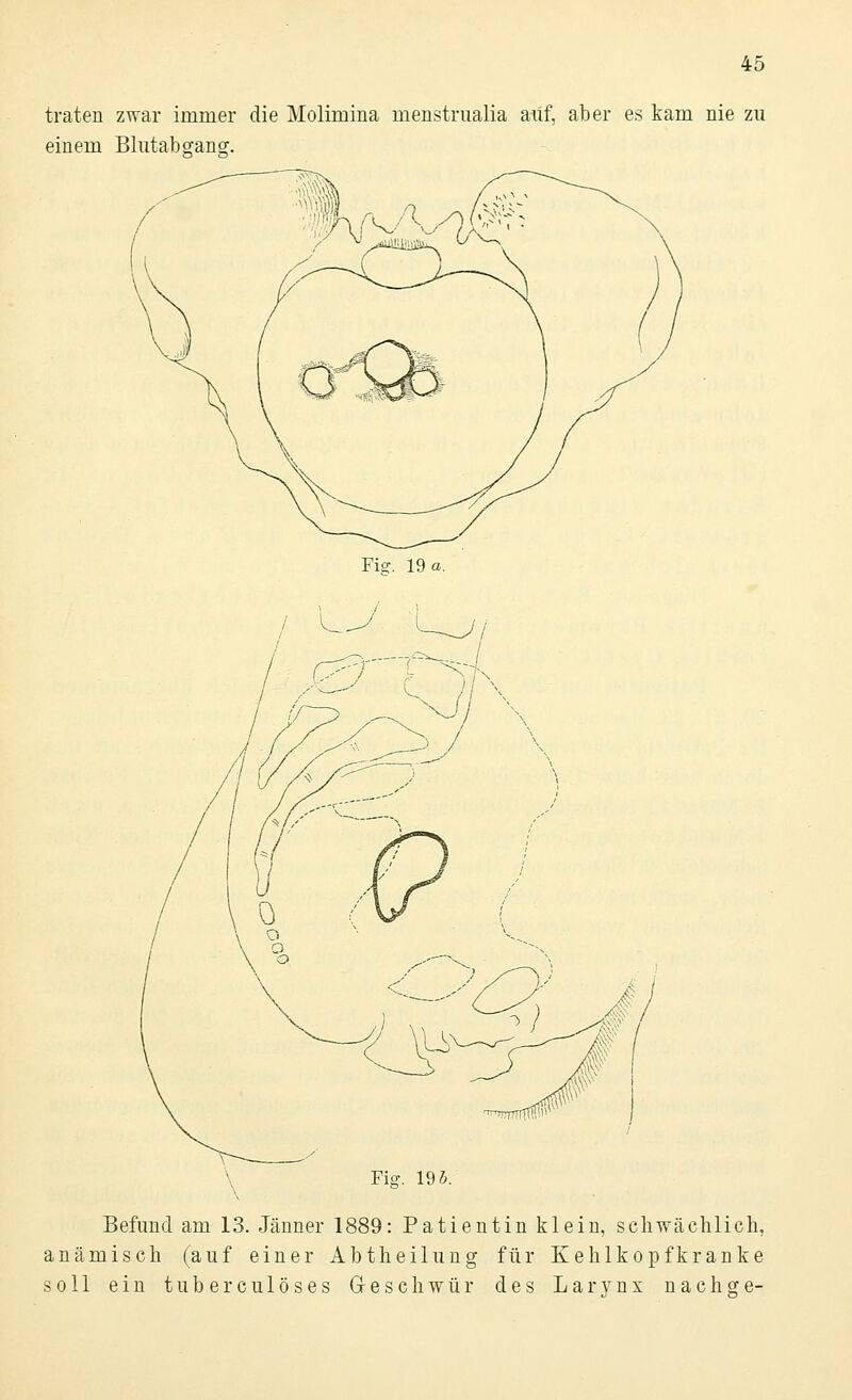 traten zwar immer die Molimina menstrualia auf, aber es kam nie zu einem Blutabgang. Piff. 19 a. Befund am 13. Jänner 1889: Patientin klein, schwächlich, anämisch (auf einer Abtheilung für Kehlkopfkranke soll ein tuberculöses Geschwür des Larynx nachge-