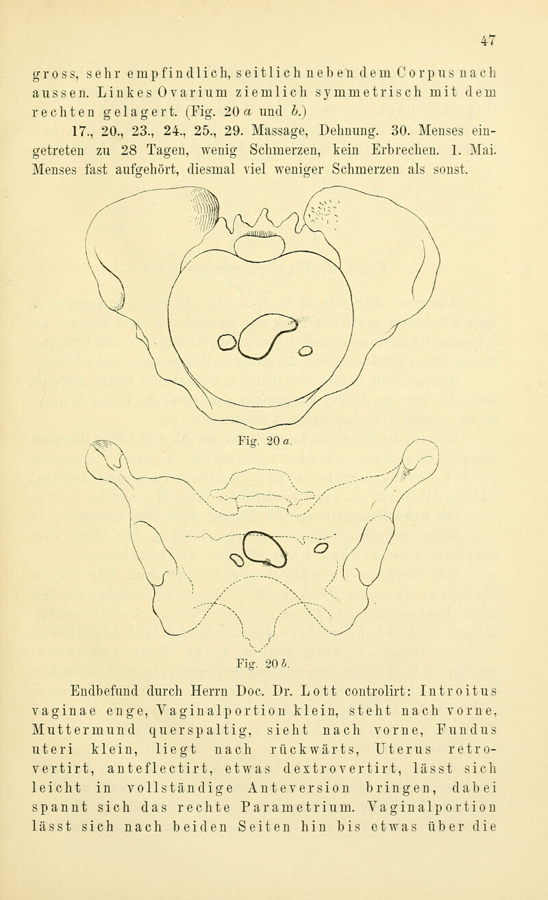 gross, sehr e in p f i n d 1 i c h, s e i 11 i c h n e b e n d e m C o r p u s n a c h aussen. Linkes Ovarium ziemlich symmetrisch mit dem rechten gelagert. (Fig. 20a und b.) 17., 20., 23., 24., 25., 29. Massage, Dehnung. 30. Menses ein- getreten zu 28 Tagen, wenig Schmerzen, kein Erbrechen. 1. Mai. Menses fast aufgehört, diesmal viel weniger Schmerzen als sonst. Fig. 20 b. Endbefund durch Herrn Doc. Dr. Lott controlirt: Introitus vaginae enge, Vaginalportion klein, steht nach vorne, Muttermund querspaltig, sieht nach vorne, Fundus uteri klein, liegt nach rückwärts, Uterus retro- vertirt, anteflectirt, etwas dextrovertirt, lässt sich leicht in vollständige Anteversion bringen, dabei spannt sich das rechte Parametrium. Vaginalportion lässt sich nach beiden Seiten hin bis etwas über die