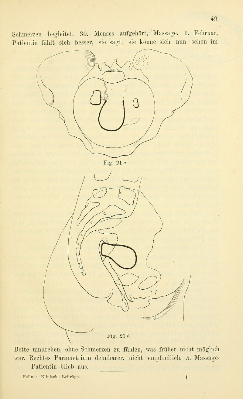 Schmerzen begleitet. 30. Menses aufgehört, Massage. 1. Februar, Patientin fühlt sich besser, sie sagt, sie könne sich nun schon im Fisr. 21 a. Fig. 2\b. Bette umdrehen, ohne Schmerzen zu fühlen, was früher nicht möglich war. Eechtes Parametrium dehnbarer, nicht empfindlich. 5. Massage- Patientin blieb aus. Fellner, Klinische Beiträge. 4