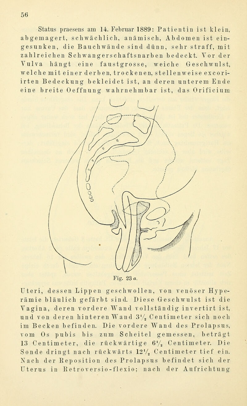 Status praesens am 14. Februar 1889: Patientin ist klein, abgemagert, schwächlich, anämisch, Abdomen ist ein- gesunken, die Bauchwände sind dünn, sehr straff, mit zahlreichen Schwang er schaftsnarben bedeckt. Vor der Yulva hängt eine faustg rosse, weiche Geschwulst, welche mit einer derben, trockenen, stellenweise excori- irten Bedeckung bekleidet ist, an deren unterem Ende eine breite Oeffnung wahrnehmbar ist, das Orificium Uteri, dessen Lippen geschwollen, von venöser Hype- rämie bläulich gefärbt sind. Diese Geschwulst ist die Vagina, deren vordere Wand vollständig invertirt ist, und von deren hinteren Wand Sl/2 Centimeter sich noch im Becken befinden. Die vordere Wand des Prolapsus, vom Os pubis bis zum Scheitel gemessen, beträgt 13 Centimeter, die rückwärtige 61/, Centimeter. Die Sonde dringt nach rückwärts 12 V2 Centimeter tief ein. Nach der Eeposition des Prolapsus befindet sich der Uterus in Eetroversio-flexio; nach der Aufrichtung