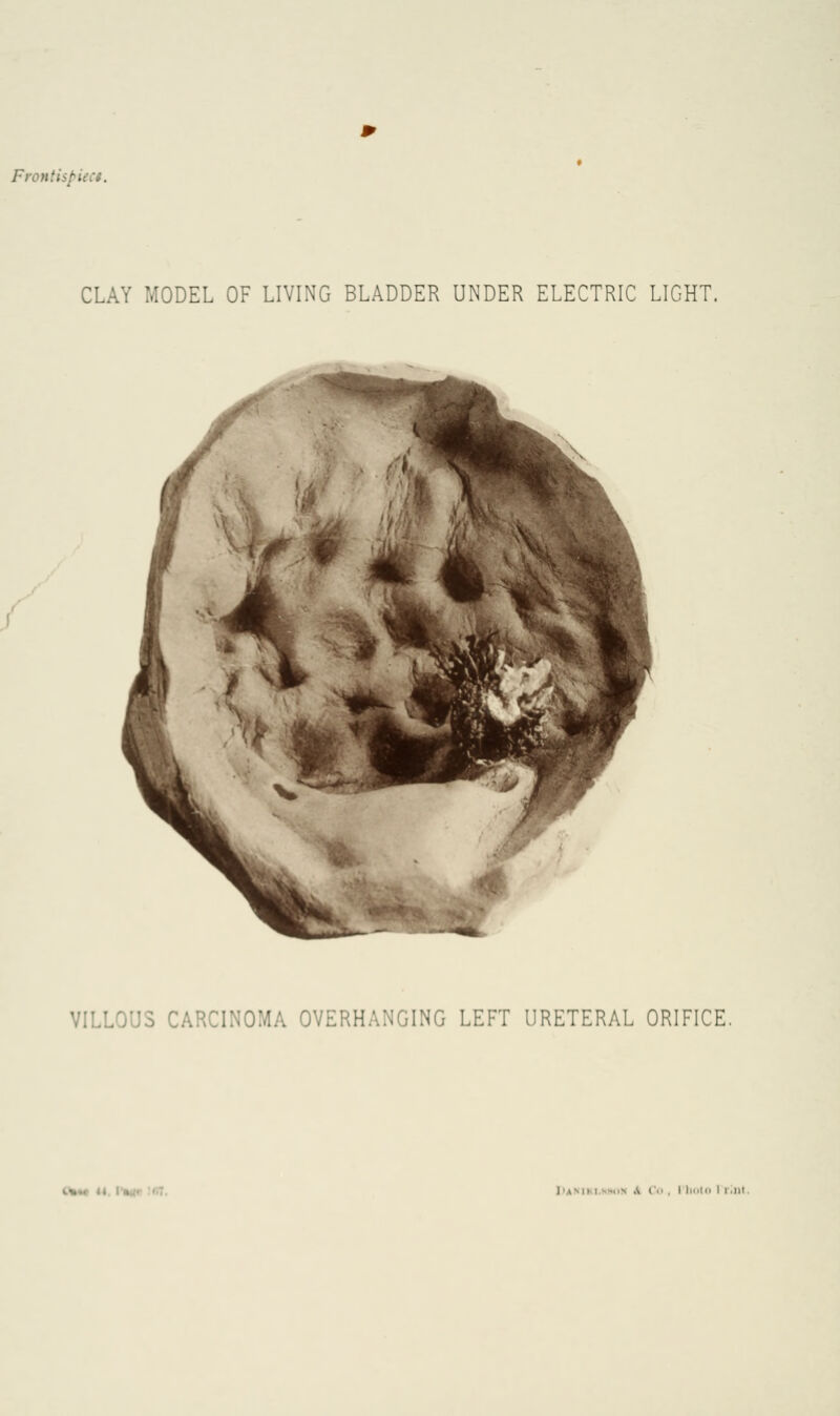 Frontispieu. CLAY MODEL OF LIVING BLADDER UNDER ELECTRIC LIGHT. VILLOUS CARCINOMA OVERHANGING LEFT URETERAL ORIFICE. I Co, i lioto i i.nt