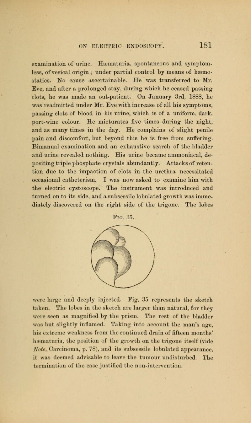 examination of urine. Hasniaturia, spontaneous and symptom- less, of vesical origin ; under partial control by means of haemo- statics. No cause ascertainable. He was transferred to Mr. Eve, and after a prolonged stay, during which he ceased passing clots, he was made an out-patient. On January 3rd, 1888, he was readmitted under Mr. Eve with increase of all his symptoms, passing clots of blood in his urine, which is of a uniform, dark, port-wine colour. He micturates five times during the night, and as many times in the day. He complains of slight penile pain and discomfort, but beyond this he is free from suffering. Bimanual examination and an exhaustive search of the bladder and urine revealed nothing. His urine became ammoniacal, de- positing triple phosphate crystals abundantly. Attacks of reten- tion due to the impaction of clots in the urethra necessitated occasional catheterism. I was now asked to examine him with the electric cystoscope. The instrument was introduced and turned on to its side, and a subsessile lobulated growth was imme- diately discovered on the right side of the trigone. The lobes Fig. 35. were large and deeply injected. Fig. 35 represents the sketch taken. The lobes in the sketch are larger than natural, for they were seen as magnified by the prism. The rest of the bladder was but slightly inflamed. Taking into account the man's age, his extreme weakness from the continued drain of fifteen months' ha3maturia, the position of the growth on the trigone itself (vide Note, Carcinoma, p. 78), and its subsessile lobulated appearance, it was deemed advisable to leave the tumour undisturbed. The termination of the case justified the non-intervention.