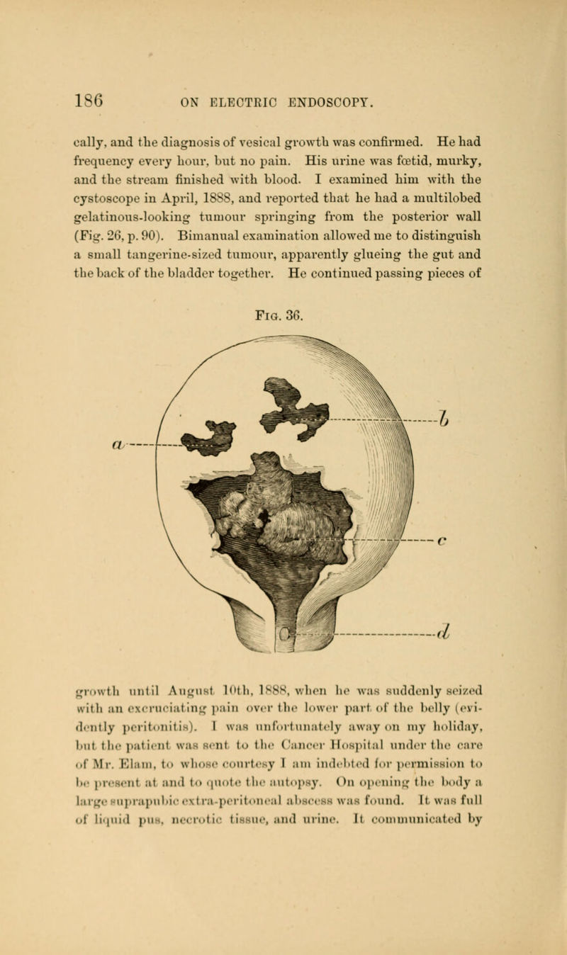 cally, and the diagnosis of vesical growth was confirmed. He had frequency every hour, but no pain. His urine was foetid, murky, and the stream finished with blood. I examined him with the cystoscope in April, 1888, and reported that he had a multilobed gelatinous-looking tumour springing from the posterior wall (Fig. Jti. p. 90). Bimanual examination allowed me to distinguish a small tangerine-sized tumour, apparently glueing the gut and the back of the bladder together. He continued passing pieces of Fig. 30. » 7> f-— r growth until Angusl LOth, L888, when he was suddenly seized irith an excruciating pain over the lower part of the belly eFi« dently peritonitis). I was unfortunately sway on my holiday, but the patient irassenl fco the Oancer Hospital under the care of Mr. Blam, to whose courtesy I am indebted for permission bo be presenl at and to quote the autopsy. < ta opening the body a large nprapnbio extra peritoneal abscess wai found, [t was full of liquid pus, necrotio tissue, and urine. Ii oommunicated by