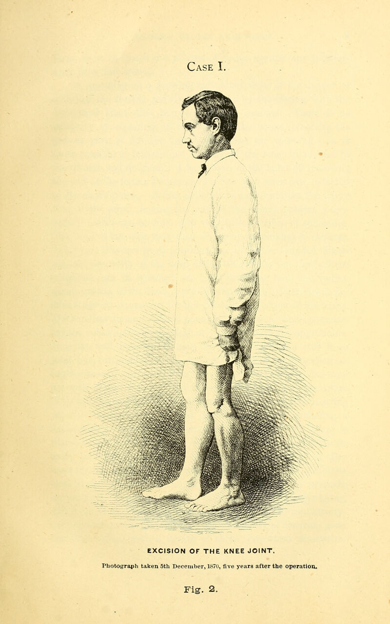 EXCISION or THE KNEE JOINT, Photograph taken 5th December, 1870, five years after the operation.