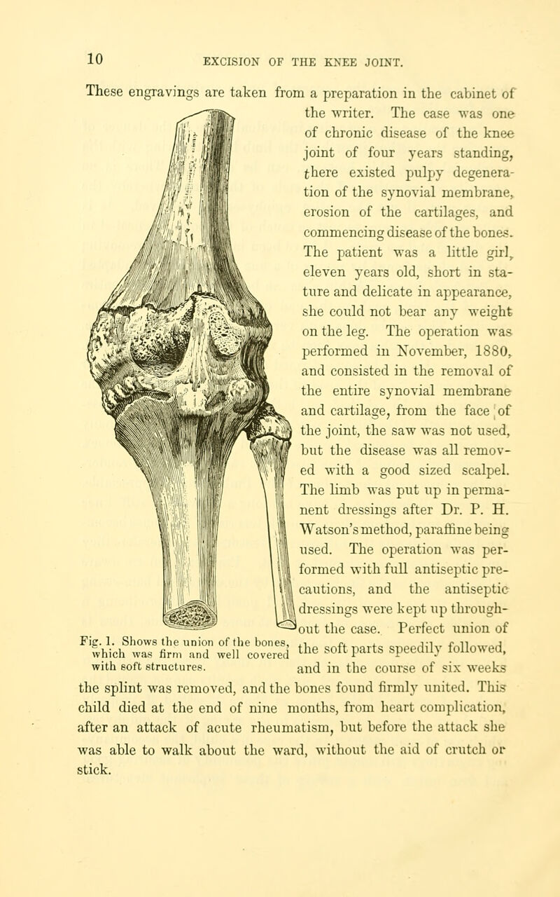 These engravings are taken from a preparation in the cabinet of the writer. The case was one of chronic disease of the knee joint of four years standing, there existed pulpy degenera- tion of the synovial membrane, erosion of the cartilages, and commencing disease of the bones. The patient was a little girl^ eleven years old, short in sta- ture and delicate in appearance, she could not bear any weight on the leg. The operation was performed in November, 1880,. and consisted in the removal of the entire synovial membrane and cartilage, from the face ' of the joint, the saw was not used, but the disease was all remov- ed with a good sized scalpel. The limb was put up in perma- nent dressings after Dr. P. H. Watson's method, paraffine being used. The operation was per- formed with full antiseptic pre- cautions, and the antiseptic dressings were kept up through- 'out the case. Perfect union of Fie. 1. Shows the union of the bones, .-i Oi. „ i.„ „ „„j,-i,. -r^n^^r^j which was firm and well covered ^be SOft parts Speedily followed. with soft structures. and in the course of six weeks the splint was removed, and the bones found firmly united. This child died at the end of nine months, from heart complication, after an attack of acute rheumatism, but before the attack she was able to walk about the ward, without the aid of crutch ov stick.