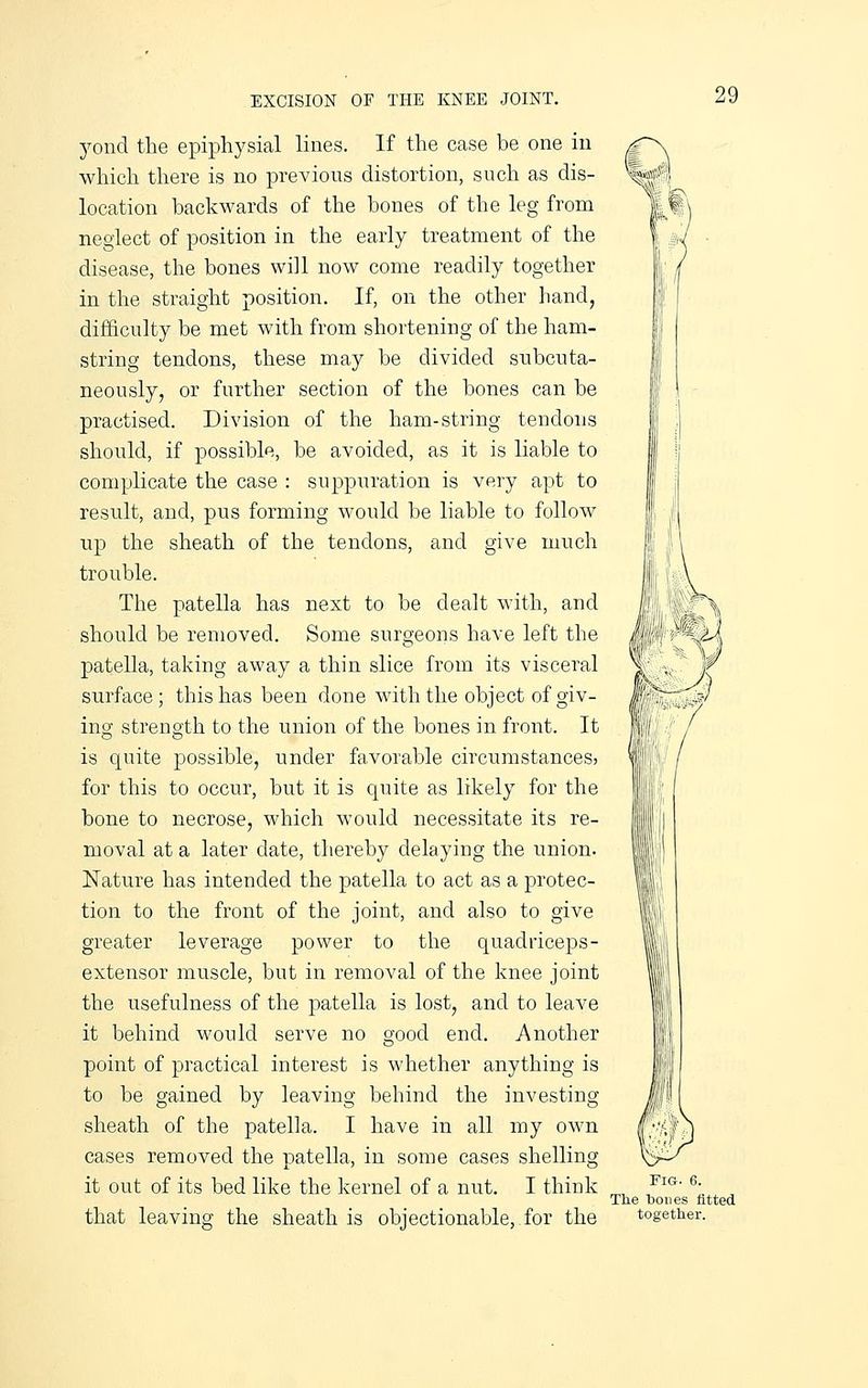 yond the epiphysial lines. If the case be one in which there is no previous distortion, such as dis- location backwards of the bones of the leg from neglect of position in the early treatment of the disease, the bones will now come readily together in the straight position. If, on the other hand, difficulty be met with from shortening of the ham- string tendons, these may be divided subcuta- neously, or further section of the bones can be practised. Division of the ham-string tendons should, if possible, be avoided, as it is liable to complicate the case : suppuration is very apt to result, and, pus forming would be liable to follow up the sheath of the tendons, and give much trouble. The patella has next to be dealt with, and should be removed. Some surgeons have left the patella, taking away a thin slice from its visceral surface; this has been done with the object of giv- ing strength to the union of the bones in front. It is quite possible, under favorable circumstancesj for this to occur, but it is quite as likely for the bone to necrose, which would necessitate its re- moval at a later date, thereby delaying the union. Nature has intended the patella to act as a protec- tion to the front of the joint, and also to give greater leverage power to the quadriceps- extensor muscle, but in removal of the knee joint the usefulness of the patella is lost, and to leave it behind would serve no good end. Another point of practical interest is whether anything is to be gained by leaving behind the investing sheath of the patella. I have in all my own cases removed the patella, in some cases shelling it out of its bed like the kernel of a nut. I think that leaving the sheath is objectionable, for the ^ Fig. 6. The tones fitted together.