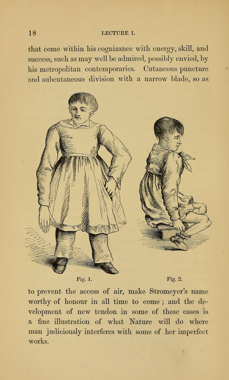 that come within his cognizance with energy, skill, and success, such as may well be admired, possibly envied, by his metropolitan contemporaries. Cutaneous puncture and subcutaneous division with a narrow blade, so as Fig. 1. Fig. 2. to prevent the access of air, make Stromeyer's name worthy of honour in all time to come ; and the de- velopment of new tendon in some of these cases is a fine illustration of what Nature will do where man judiciously interferes with some of her imperfect works.
