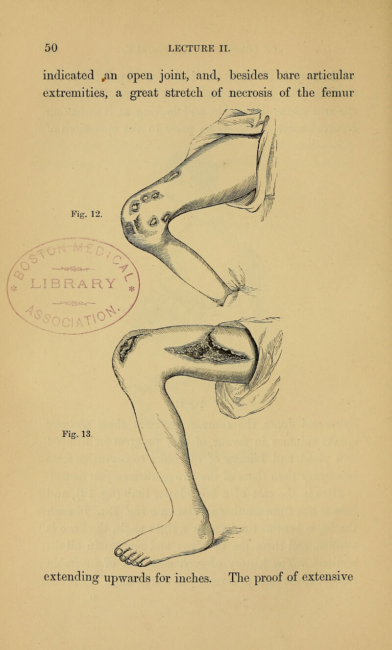 indicated ,an open joint, and, besides bare articular extremities, a great stretcb of necrosis of the femur '<; Fig. 12. LIBRARY '' Fig.13 extending upwards for inches. The proof of extensive