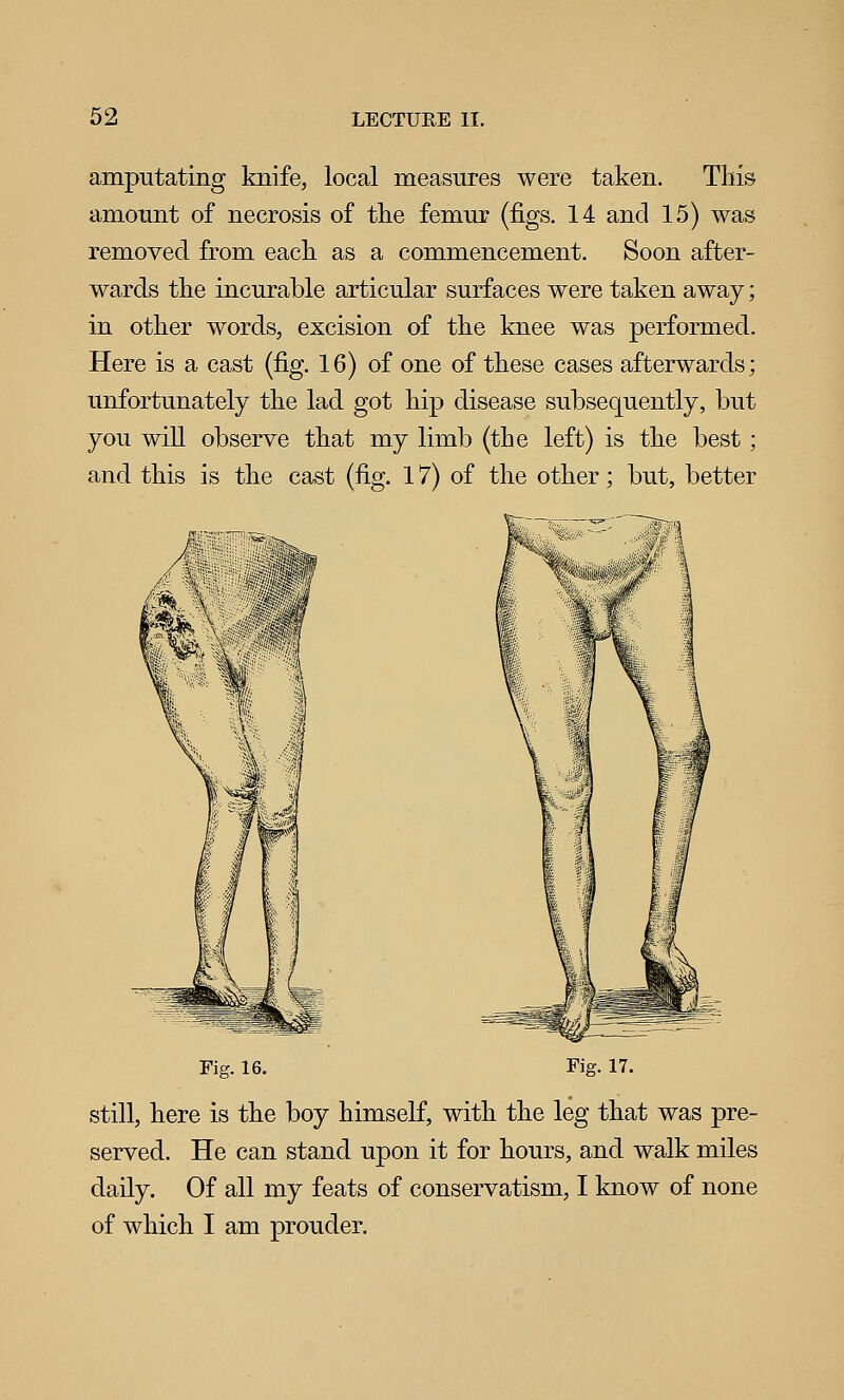 amputating knife, local measures were taken. This amount of necrosis of the femur (figs. 14 and 15) was removed from each as a commencement. Soon after- wards the incurable articular surfaces were taken away; in other words, excision of the knee was performed. Here is a cast (fig. 16) of one of these cases afterwards; unfortunately the lad got hip disease subsequently, but you wiU observe that my limb (the left) is the best; and this is the cast (fig. 17) of the other; but, better Fig. 16. Fig. 17. still, here is the boy himself, with the leg that was pre- served. He can stand upon it for hours, and walk miles daily. Of all my feats of conservatism, I know of none of which I am prouder.