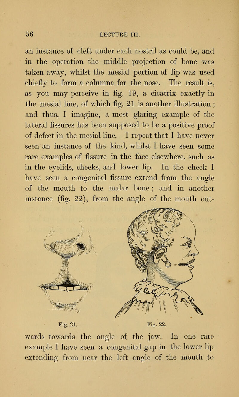 an instance of cleft under each nostril as could be, and in the operation the middle projection of bone was taken away, whilst the mesial portion of lip was used chiefly to form a columna for the nose. The result is, as you may perceive in fig. 19, a cicatrix exactly in the mesial line, of which fig. 21 is another illustration ; and thus, I imagine, a most glaring example of the lateral fissures has been supposed to be a positive proof of defect in the mesial line. I repeat that I have never seen an instance of the kind, whilst I have seen some rare examples of fissure in the face elsewhere, such as in the eyehds, cheeks, and lower lip. In the cheek I have seen a congenital fissure extend from the angle of the mouth to the malar bone; and in another instance (fig. 22), from the angle of the mouth out- Fig. 21. Fig. 22. wards towards the angle of the jaw. In one rare example I have seen a congenital gap in the lower lip extending from near the left angle of the mouth to