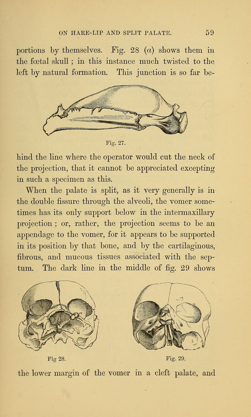 portions by themselves. Fig. 28 (a) shows them in the foetal skull; in this instance much twisted to the left by natural formation. This junction is so far be- Fie. 27. hind the line where the operator would cut the neck of the projection, that it cannot be appreciated excepting in such a specimen as this. When the palate is split, as it very generally is in the double fissure through the alveoli, the vomer some- times has its only support below in the intermaxillary projection ; or, rather, the projection seems to be an appendage to the vomer, for it appears to be supported in its position by that bone, and by the cartilaginous, fibrous, and mucous tissues associated with the sep- tum. The dark line in the middle of fig. 29 shows Fig 28. Fig. 29. the lower margin of the vomer in a cleft palate, and