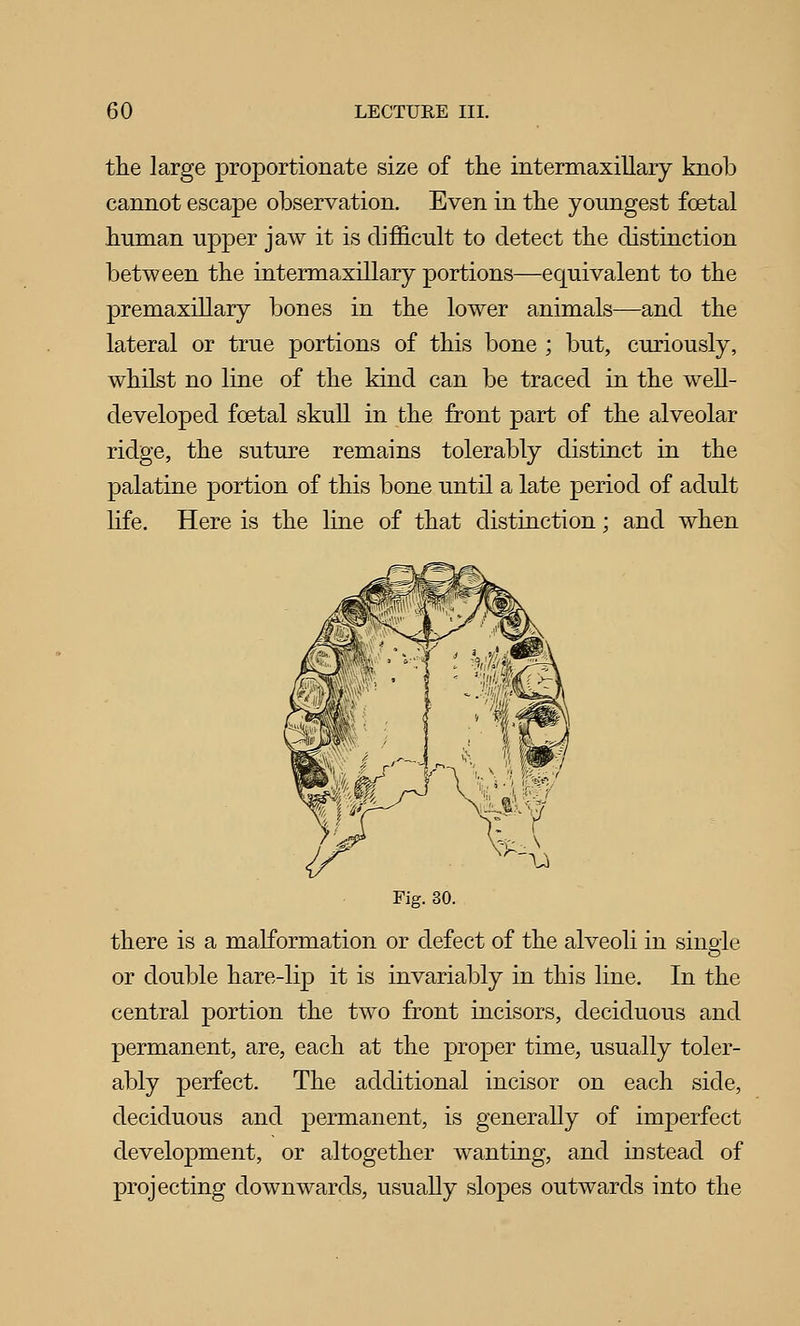 the large proportionate size of the intermaxillary knob cannot escape observation. Even in the youngest foetal human upper jaw it is difl&cult to detect the distinction between the intermaxillary portions—equivalent to the premaxillary bones in the lower animals—and the lateral or true portions of this bone ; but, curiously, whilst no line of the kind can be traced in the well- developed foetal skull in the front part of the alveolar ridge, the suture remains tolerably distinct in the palatine portion of this bone until a late period of adult life. Here is the line of that distinction; and when Fig. 30. there is a malformation or defect of the alveoli in single or double hare-lip it is invariably in this line. In the central portion the two front incisors, deciduous and permanent, are, each at the proper time, usually toler- ably perfect. The additional incisor on each side, deciduous and permanent, is generally of imperfect development, or altogether wanting, and instead of projecting downwards, usually slopes outwards into the