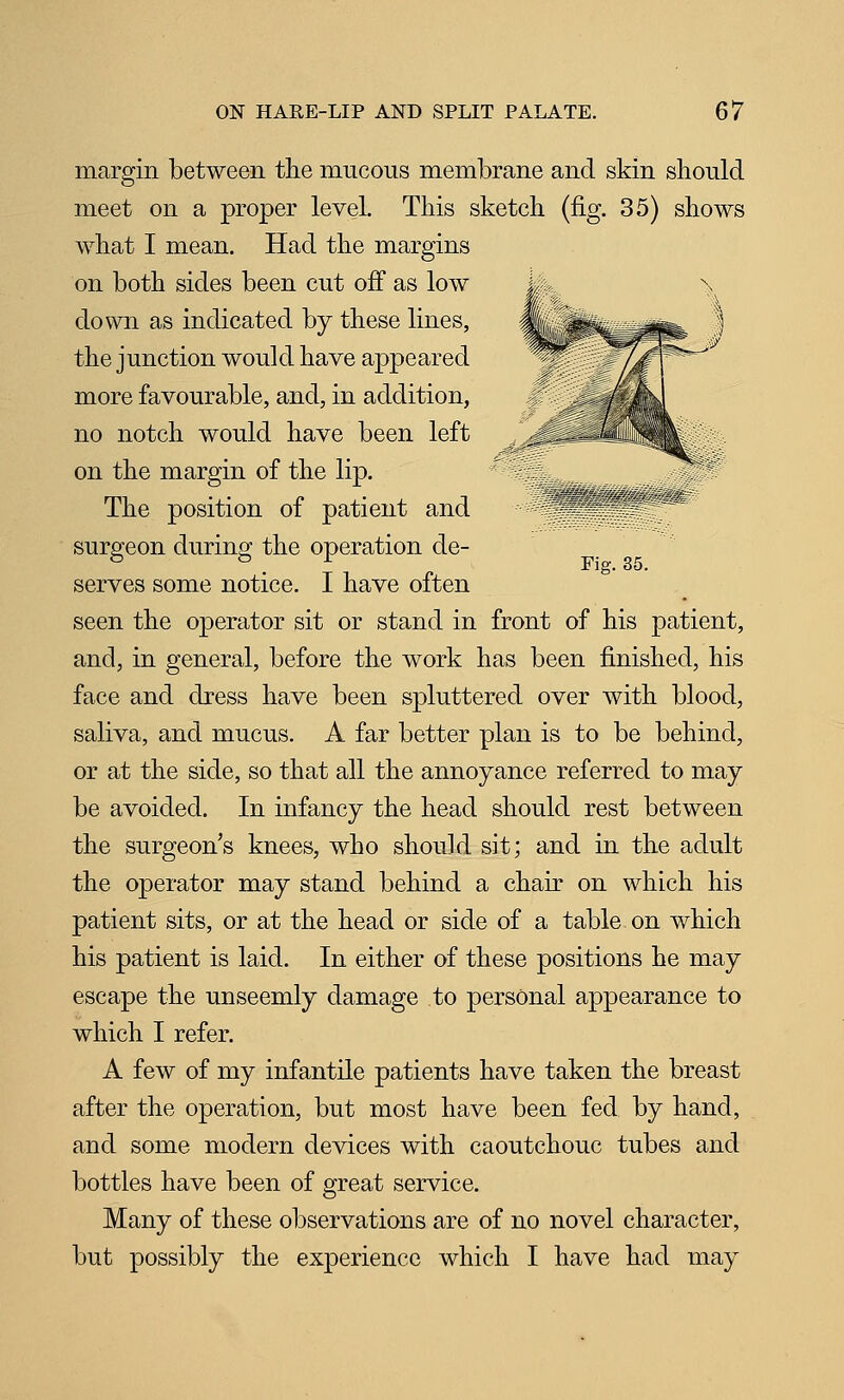 margin between the mucous membrane and skin should meet on a proper level. This sketch (fig. 35) shows what I mean. Had the margins on both sides been cut off as low down as indicated by these lines, the junction would have appeared more favourable, and, in addition, no notch would have been left on the margin of the lip. The position of patient and ^.^«.-^^k^^ surgreon during; the operation de- ^ . Fig. 35. serves some notice. I have often seen the operator sit or stand in front of his patient, and, in general, before the work has been finished, his face and dress have been spluttered over with blood, saliva, and mucus. A far better plan is to be behind, or at the side, so that all the annoyance referred to may be avoided. In infancy the head should rest between the surgeon's knees, who should sit; and in the adult the operator may stand behind a chair on which his patient sits, or at the head or side of a table on which his patient is laid. In either of these positions he may escape the unseemly damage to personal appearance to which I refer. A few of my infantile patients have taken the breast after the operation, but most have been fed by hand, and some modern devices with caoutchouc tubes and bottles have been of great service. Many of these observations are of no novel character, but possibly the experience which I have had may