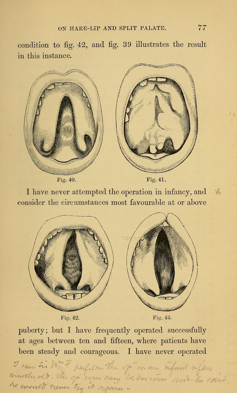 condition to fig. 42, and fig. 39 illustrates the result in this instance. Fig. 40. Fig. 41. I have never attempted the operation in infancy, and ^: consider the circumstances most favourable at or above Fi-. 42. Fig. 43. puberty; but I have frequently operated successfully at ages between ten and fifteen, where patients have been steady and courageous. I have never operated ^ ^iA*Ht.€(^ ^?tc^t**^ ^L t4^ ^tfift'^i,.