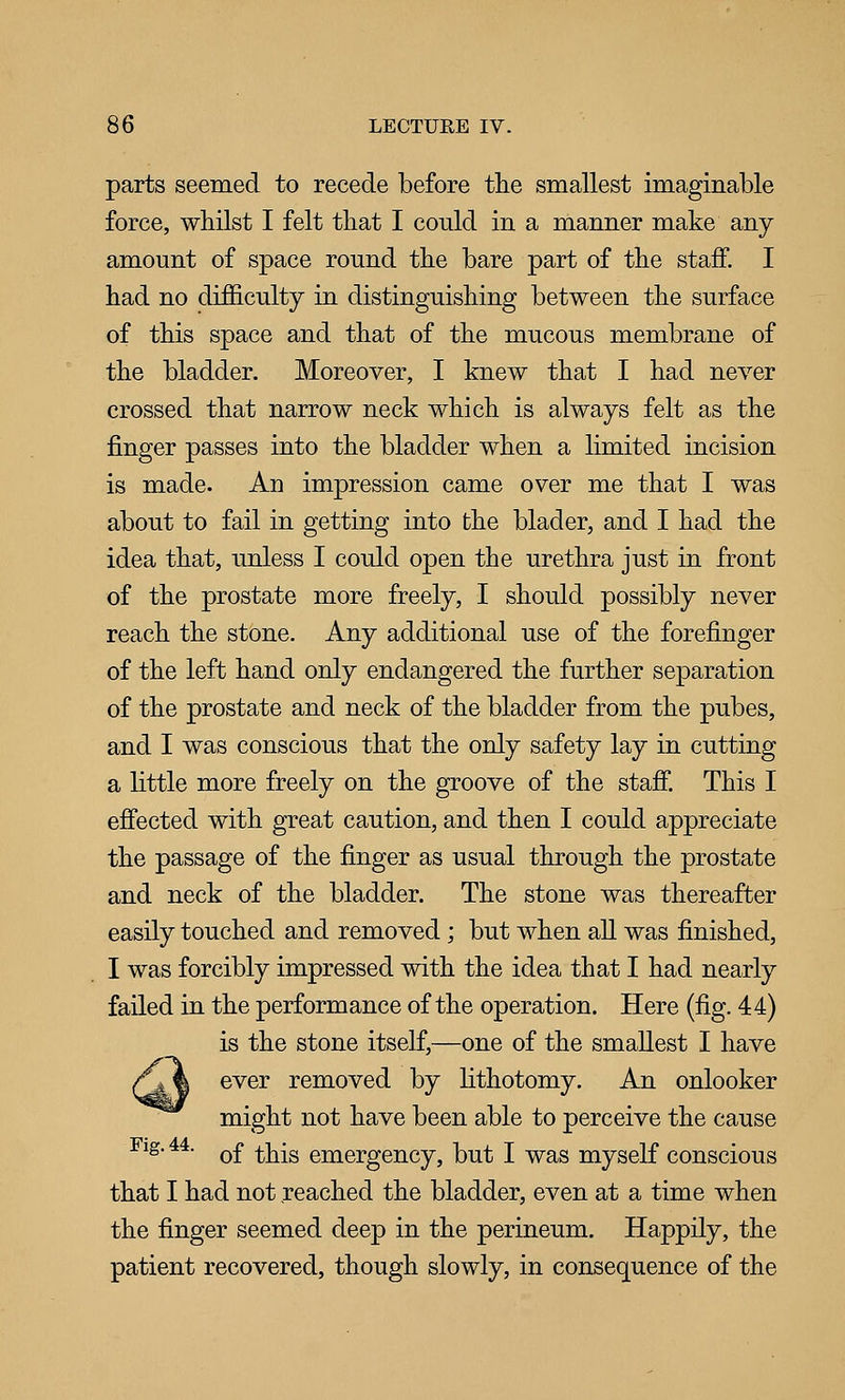 parts seemed to recede before the smallest imaginable force, whilst I felt that I could in a manner make any amount of space round the bare part of the staff. I had no difficulty in distinguishing between the surface of this space and that of the mucous membrane of the bladder. Moreover, I knew that I had never crossed that narrow neck which is always felt as the finger passes into the bladder when a limited incision is made. An impression came over me that I was about to fail in getting into the blader, and I had the idea that, unless I could open the urethra just in front of the prostate more freely, I should possibly never reach the stone. Any additional use of the forefinger of the left hand only endangered the further separation of the prostate and neck of the bladder from the pubes, and I was conscious that the only safety lay in cutting a little more freely on the groove of the stafi. This I effected with great caution, and then I could appreciate the passage of the finger as usual through the prostate and neck of the bladder. The stone was thereafter easily touched and removed; but when all was finished, I was forcibly impressed with the idea that I had nearly failed in the performance of the operation. Here (fig. 44) is the stone itself,—one of the smallest I have ever removed by lithotomy. An onlooker might not have been able to perceive the cause Fig. 44. ^£ ^i^^g emergency, but I was myself conscious that I had not reached the bladder, even at a time when the finger seemed deep in the perineum. Happily, the patient recovered, though slowly, in consequence of the