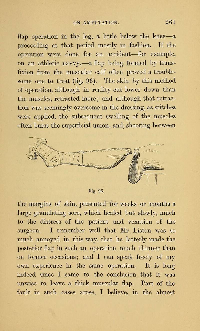 flap operation in the leg, a little below the knee—a proceeding at that period mostly in fashion. If the operation were done for an accident—for example, on an athletic navvy,—a flap being formed by trans- fixion from the muscular calf often proved a trouble- some one to treat (fig. 96). The skin by this method of operation, although in reality cut lower down than the muscles, retracted more; and although that retrac- tion was seemingly overcome in the dressing, as stitches were applied, the subsequent swelling of the muscles often burst the superficial union, and, shooting between Fig. 96. the margins of skin, presented for weeks or months a large granulating sore, which healed but slowly, much to the distress of the patient and vexation of the surgeon. I remember weU that Mr Liston was so much annoyed in this way, that he latterly made the posterior flap in such an operation much thinner than on former occasions; and I can speak freely of my own experience in the same operation. It is long indeed since I came to the conclusion that it was unwise to leave a thick muscular flap. Part of the fault in such cases arose, I believe, in the almost