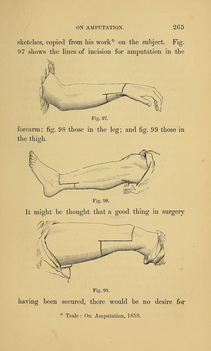sketches, copied from his work on the subject. Fig. 97 shows the lines of incision for amputation in the Fig. 97. forearm; fig. 98 those in the leg; and fig. 99 those in the thigh. Fig. 98. It might be thought that a good thing in surgery Fig. 99. having been secured, there would be no desire for * Teale : On Amputation, 1858.