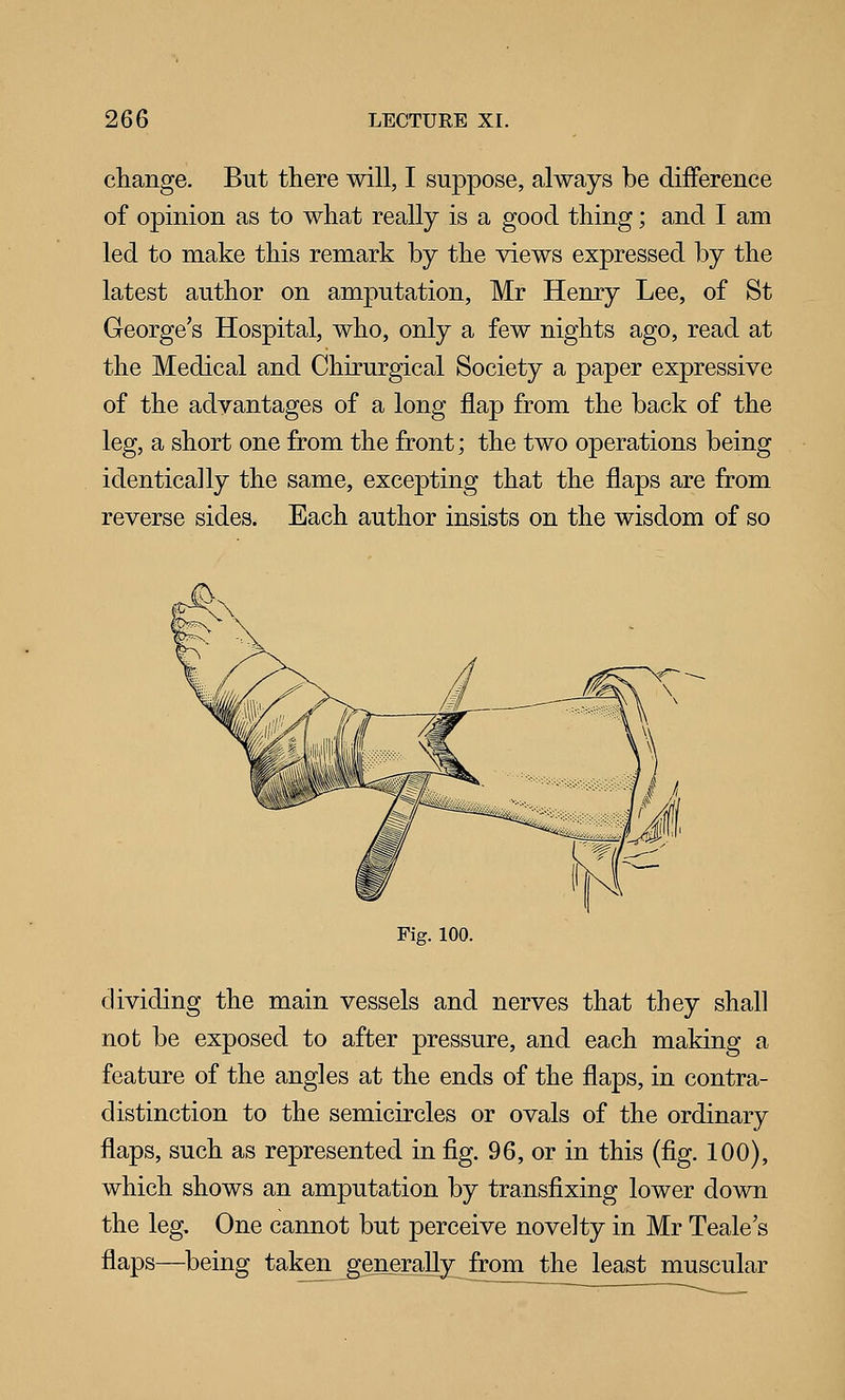 change. But there will, I suppose, always be difference of opinion as to what really is a good thing; and I am led to make this remark by the views expressed by the latest author on amputation, Mr Henry Lee, of St George's Hospital, who, only a few nights ago, read at the Medical and Chirurgical Society a paper expressive of the advantages of a long flap from the back of the leg, a short one from the front; the two operations being identically the same, excepting that the flaps are from reverse sides. Each author insists on the wisdom of so Fig. 100. dividing the main vessels and nerves that they shall not be exposed to after pressure, and each making a feature of the angles at the ends of the flaps, in contra- distinction to the semicircles or ovals of the ordinary flaps, such as represented in fig. 96, or in this (fig. 100), which shows an amputation by transfixing lower down the leg. One cannot but perceive novelty in Mr Teale's flaps—^being taken generally^ from the least muscular