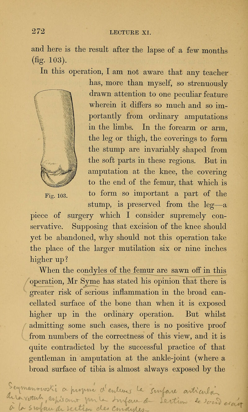Fig. 103. and here is the result after the lapse of a few months (fig. 103). In this operation, I am not aware that any teacher has, more than myself, so strenuously drawn attention to one peculiar feature wherein it differs so much and so im- portantly from ordinary amputations in the limbs. In the forearm or arm, the leg or thigh, the coverings to form the stump are invariably shaped from the soft parts in these regions. But in amputation at the knee, the covering to the end of the femur, that which is to form so important a part of the stump, is preserved from the leg—a piece of surgery which I consider supremely con- servative. Supposing that excision of the knee should yet be abandoned, why should not this operation take the place of the larger mutilation six or nine inches higher up? When the condyles of the femur are sawn off in this / operation, Mr Syme has stated his opinion that there is ' greater risk of serious inflammation in the broad can- cellated surface of the bone than when it is exposed higher up in the ordinary operation. But whilst admitting some such cases, there is no positive proof ' from numbers of the correctness of this view, and it is quite contradicted by the successful practice of that gentleman in amputation at the ankle-joint (where a broad surface of tibia is almost always exposed by the e^c