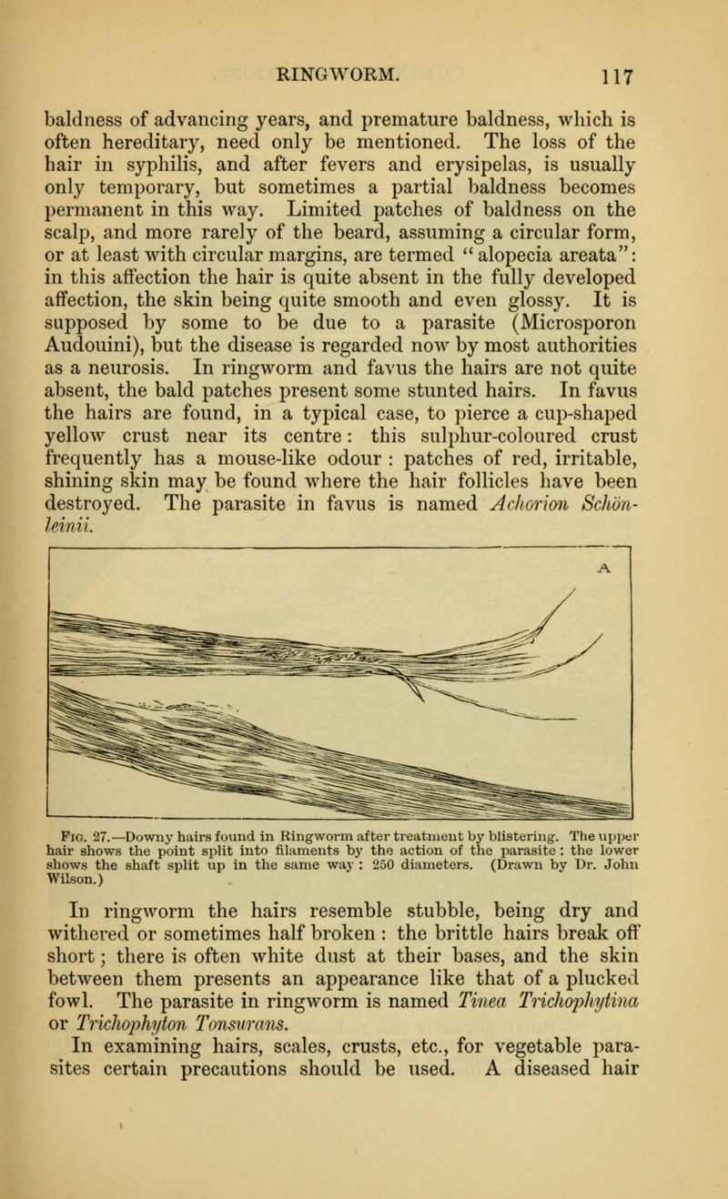 baldness of advancing years, and premature baldness, which is often hereditary, need only be mentioned. The loss of the hair in syphilis, and after fevers and erysipelas, is usually only temporary, but sometimes a partial baldness becomes permanent in this way. Limited patches of baldness on the scalp, and more rarely of the beard, assuming a circular form, or at least with circular margins, are termed  alopecia areata: in this affection the hair is quite absent in the fully developed affection, the skin being quite smooth and even glossy. It is supposed by some to be due to a parasite (Microsporon Audouini), but the disease is regarded now by most authorities as a neurosis. In ringworm and favus the hairs are not quite absent, the bald patches present some stunted hairs. In favus the hairs are found, in a typical case, to pierce a cup-shaped yellow crust near its centre: this sulphur-coloured crust frequently has a mouse-like odour : patches of red, irritable, shining skin may be found where the hair follicles have been destroyed. The parasite in favus is named Acliorion Schon- leinii. Pig. 27.—Downy hairs found in Ringworm after treatment by blistering. The upper hair shows the point split into filaments by the action of the parasite : the lower shows the shaft split up in the same way : 250 diameters. (Drawn by Dr. John Wilson.) In ringworm the hairs resemble stubble, being dry and withered or sometimes half broken : the brittle hairs break off short; there is often white dust at their bases, and the skin between them presents an appearance like that of a plucked fowl. The parasite in ringworm is named Ti7iea Trichophytina or Trichophyton Tonsurans. In examining hairs, scales, crusts, etc., for vegetable para- sites certain precautions should be used. A diseased hair