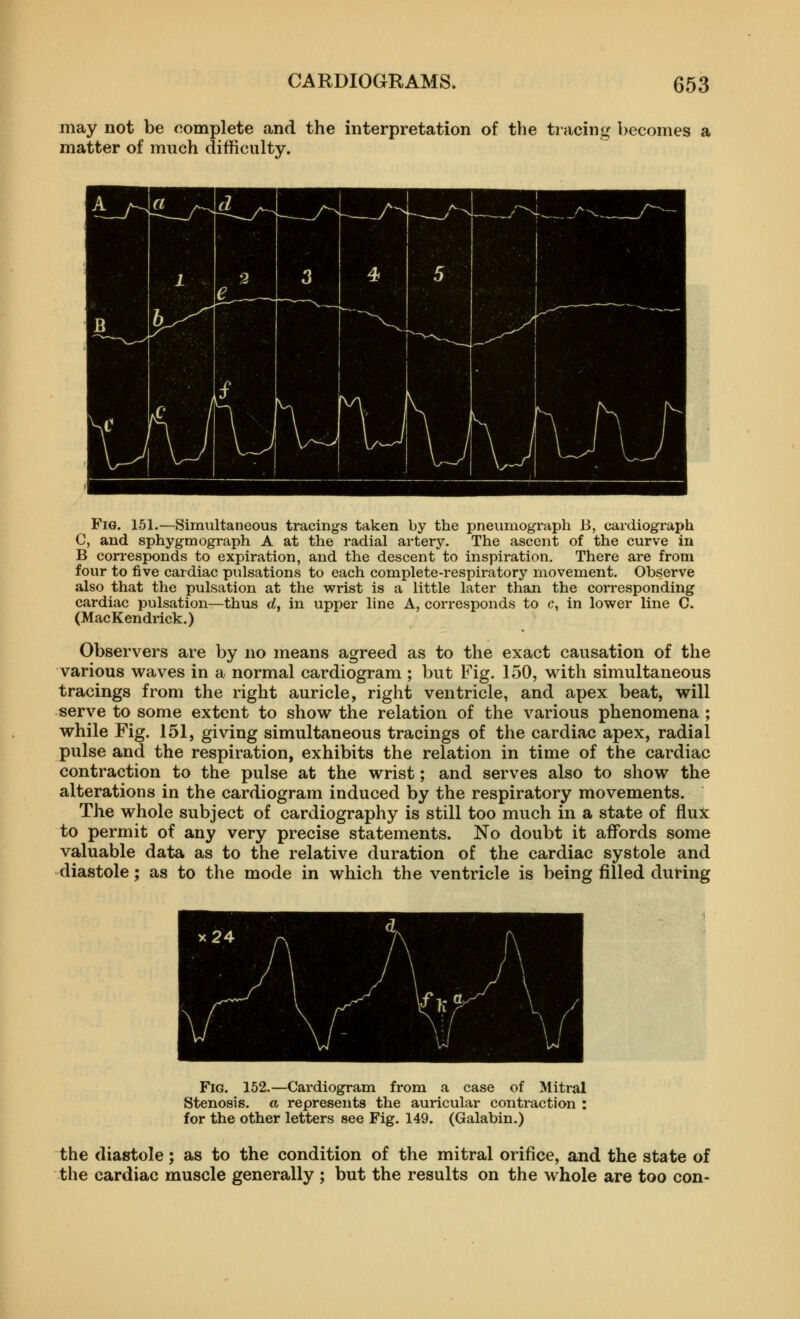 may not be complete and the interpretation of the tracing becomes a matter of much difficulty. Fig. 151.—Simultaneous tracings taken by the pneumograph B, cardiograph C, and sphygmograph A at the radial artery. The ascent of the curve in B corresponds to expiration, and the descent to inspiration. There are from four to five cardiac pulsations to each complete-respiratory movement. Observe also that the pulsation at the wrist is a little later than the corresponding cardiac pulsation—thus d, in upper line A, corresponds to c, in lower line C. (MacKendrick.) Observers are by no means agreed as to the exact causation of the various waves in a normal cardiogram ; but Fig. 150, with simultaneous tracings from the right auricle, right ventricle, and apex beat, will serve to some extent to show the relation of the various phenomena ; while Fig. 151, giving simultaneous tracings of the cardiac apex, radial pulse and the respiration, exhibits the relation in time of the cardiac contraction to the pulse at the wrist; and serves also to show the alterations in the cardiogram induced by the respiratory movements. The whole subject of cardiography is still too much in a state of flux to permit of any very precise statements. No doubt it affords some valuable data as to the relative duration of the cardiac systole and diastole; as to the mode in which the ventricle is being filled duHng Fig. 152.—Cardiogram from a case of Mitral Stenosis, a represents the auricular contraction : for the other letters see Fig. 149. (Galabin.) the diastole; as to the condition of the mitral orifice, and the state of the cardiac muscle generally ; but the results on the whole are too con-