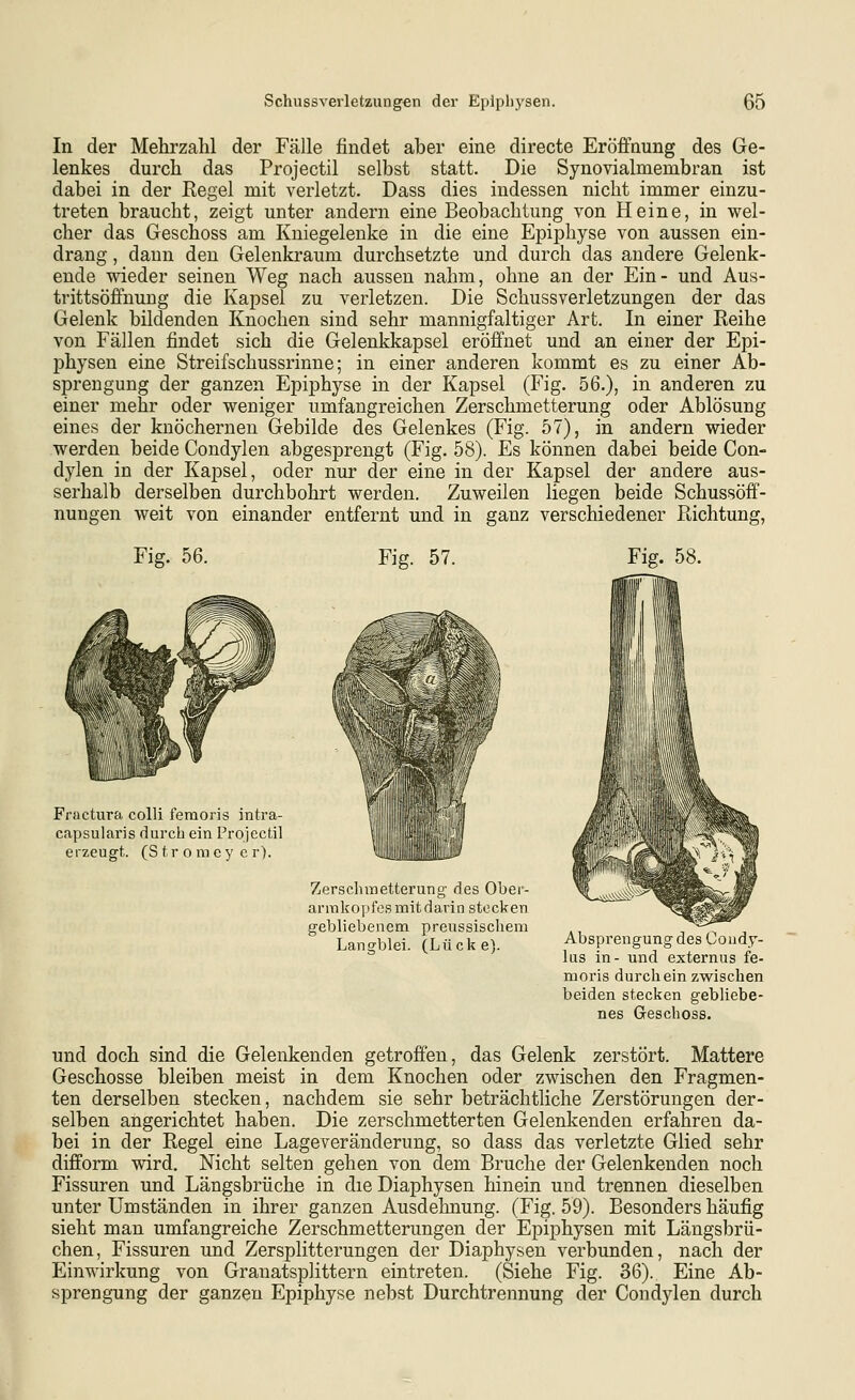 In der Mehrzahl der Fälle findet aber eine directe Eröffnung des Ge- lenkes durch das Projectil selbst statt. Die Synovialmembran ist dabei in der Regel mit verletzt. Dass dies indessen nicht immer einzu- treten braucht, zeigt unter andern eine Beobachtung von Heine, in wel- cher das Geschoss am Kniegelenke in die eine Epiphyse von aussen ein- drang , dann den Gelenkraum durchsetzte und durch das andere Gelenk- ende wieder seinen Weg nach aussen nahm, ohne an der Ein- und Aus- trittsöffnung die Kapsel zu verletzen. Die Schussverletzungen der das Gelenk bildenden Knochen sind sehr mannigfaltiger Art. In einer Reihe von Fällen findet sich die Gelenkkapsel eröffnet und an einer der Epi- physen eine Streifschussrinne; in einer anderen kommt es zu einer Ab- sprengung der ganzen Epiphyse in der Kapsel (Fig. 56.), in anderen zu einer mehr oder weniger umfangreichen Zerschmetterung oder Ablösung eines der knöchernen Gebilde des Gelenkes (Fig. 57), in andern wieder werden beide Condylen abgesprengt (Fig. 58). Es können dabei beide Con- dylen in der Kapsel, oder nur der eine in der Kapsel der andere aus- serhalb derselben durchbohrt werden. Zuweilen liegen beide Schussöff- nungen weit von einander entfernt und in ganz verschiedener Richtung, Fig. 56. Fig. 57. Fig. 58. Fractura colli femoris intra- capsularis durch ein Projectil erzeugt. (S tr o mcy c r). Zerschmetterung des Obei'- arrakopfos mit darin stecken gebliebenem preussischem Langblei. (Lücke). Absprengung des Coudy- lus in- und externus fe- moris durch ein zwischen beiden stecken gebliebe- nes Geschoss. und doch sind die Gelenkenden getroffen, das Gelenk zerstört. Mattere Geschosse bleiben meist in dem Knochen oder zwischen den Fragmen- ten derselben stecken, nachdem sie sehr beträchtliche Zerstörungen der- selben angerichtet haben. Die zerschmetterten Gelenkenden erfahren da- bei in der Regel eine Lageveränderung, so dass das verletzte Glied sehr difform wird. Nicht selten gehen von dem Bruche der Gelenkenden noch Fissuren und Längsbrüche in die Diaphysen hinein und trennen dieselben unter Umständen in ihrer ganzen Ausdehnung. (Fig. 59). Besonders häufig sieht man umfangreiche Zerschmetterungen der Epiphysen mit Längsbrü- chen, Fissuren und Zersplitterungen der Diaphysen verbunden, nach der Einwirkung von Granatsplittern eintreten. (Siehe Fig. 36). Eine Ab- sprengung der ganzen Epiphyse nebst Durchtrennung der Condylen durch