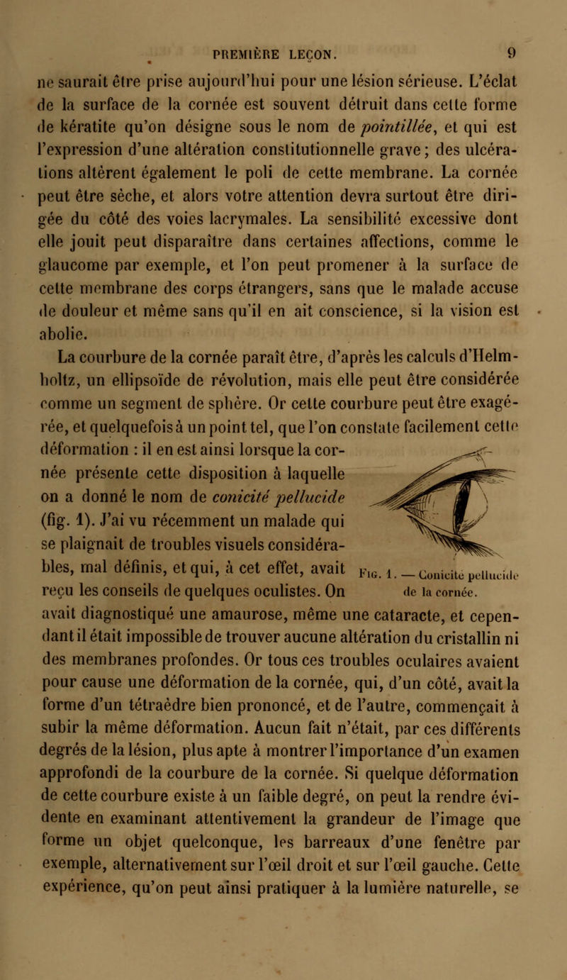 ne saurait être prise aujourd'hui pour une lésion sérieuse. L'éclat de la surface de la cornée est souvent détruit dans cette forme de kératite qu'on désigne sous le nom de pointillée, et qui est l'expression d'une altération constitutionnelle grave; des ulcéra- tions altèrent également le poli de cette membrane. La cornée peut être sèche, et alors votre attention devra surtout être diri- gée du côté des voies lacrymales. La sensibilité excessive dont elle jouit peut disparaître dans certaines affections, comme le glaucome par exemple, et l'on peut promener à la surface cîe cette membrane des corps étrangers, sans que le malade accuse de douleur et même sans qu'il en ait conscience, si la vision est abolie. La courbure de la cornée paraît être, d'après les calculs d'Helm- holtz, un ellipsoïde de révolution, mais elle peut être considérée comme un segment de sphère. Or cette courbure peut être exagé- rée, et quelquefois à un point tel, que l'on constate facilement cette déformation : il en est ainsi lorsque la cor- née présente cette disposition à laquelle on a donné le nom de conicité pellitcidr (fig. 1). J'ai vu récemment un malade qui se plaignait de troubles visuels considéra- bles, mal définis, et qui, à cet effet, avait Fl6. i._ComcilcpclUu;i(,, reçu les conseils de quelques oculistes. On de la cornée, avait diagnostiqué une amaurose, même une cataracte, et cepen- dant il était impossible de trouver aucune altération du cristallin ni des membranes profondes. Or tous ces troubles oculaires avaient pour cause une déformation de la cornée, qui, d'un côté, avait la forme d'un tétraèdre bien prononcé, et de l'autre, commençait à subir la même déformation. Aucun fait n'était, par ces différents degrés de la lésion, plus apte à montrer l'importance d'un examen approfondi de la courbure de la cornée. Si quelque déformation de cette courbure existe à un faible degré, on peut la rendre évi- dente en examinant attentivement la grandeur de l'image que forme un objet quelconque, les barreaux d'une fenêtre par exemple, alternativement sur l'œil droit et sur l'œil gauche. Cette expérience, qu'on peut ainsi pratiquer à la lumière naturelle, se