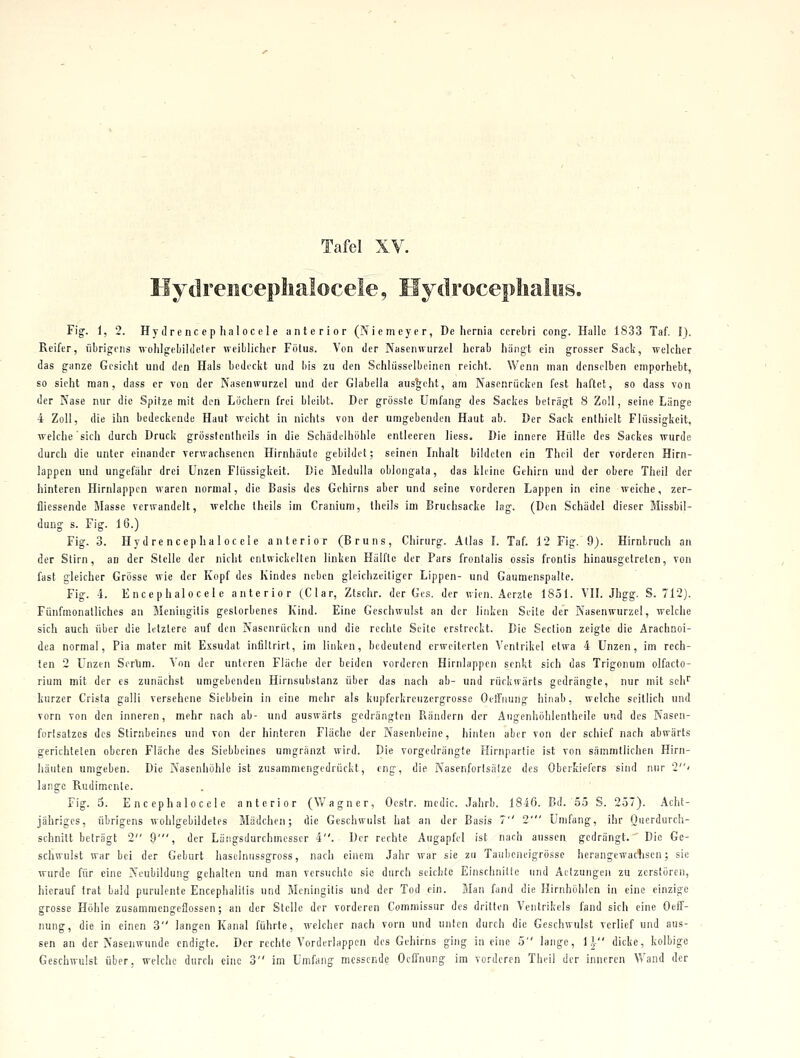 Hydreiiceplialocele, Hydrocepliaies. Fig. 1, 2. Hydreiicephaloccle anterior (Niemeyer, De hernia ccrebri coiig. Halle 1833 Taf. I). Reifer, übrigens wohlgebildeler weiblicher Fötus. Von der Nasenwurzel herab hängt ein grosser Sack, welcher das ganze Gesicht und den Hals bedeckt und bis zu den Schlüsselbeinen reicht. Wenn man denselben emporhebt, so sieht man, dass er von der Nasenwurzel und der Glabella aus*;oht, am Nasenrücken fest haftet, so dass von der Nase nur die Spitze mit den Löchern frei bleibt. Der grösste Umfang des Sackes belrägt 8 Zoll, seine Länge 4 Zoll, die ihn bedeckende Haut weicht in nichts von der umgebenden Haut ab. Der Sack enthielt Flüssigkeit, welche sich durch Druck grösstcnlhcils in die Schädelhöhle entleeren liess. Die innere Hülle des Sackes wurde durch die unter einander verwachsenen Hirnhäute gebildet; seinen Inhalt bildeten ein Thcil der vorderen Hirn- lappen und ungefähr drei Unzen Flüssigkeit. Die Medulla oblongata, das kleine Gehirn und der obere Theil der hinteren Hirnlappen waren normal, die Basis des Gehirns aber und seine vorderen Lappen in eine weiche, zer- fliessende Masse verwandelt, welche Iheils im Cranium, theils im Bruchsacke lag. (Den Schädel dieser Missbil- dung s. Fig. 16.) Fig. 3. Hydrencephaloc ele anterior (Bruns, Chirurg. Alias L Taf. 12 Fig. 9). Hirnlruch an der Slirn, an der Stelle der nicht entwickelten linken Hälfte der Pars frontalis ossis frontis hinausgetreten, von fast gleicher Grösse wie der Kopf des Kindes neben gleichzeitiger Lippen- und Gaumenspalte. Fig. 4. Encephalocel e anterior (Clar, Ztschr. der Ges. der wien. Aerzte 1851. VIL Jhgg. S. 712). Fünfmonatliches an Meningitis gestorbenes Kind. Eine Geschwulst an der linken Seite der Nasenwurzel, welche sich auch über die letzlere auf den Nasenrücken und die rechte Seile erstreckt. Die Section zeigte die Arachnoi- dea normal, Pia matcr mit Exsudat infillrirt, im linken, bedeutend erweiterten Ventrikel etwa 4 Unzen, im rech- ten 2 Unzen Sertim. Von der unteren Fläche der beiden vorderen Hirnlappen senkt sich das Trigonum olfacto- rium mit der es zunächst umgebenden Hirnsubslanz über das nach ab- und rückwärts gedrängte, nur mit seh kurzer Crista galli versehene Siebbein in eine mehr als kupferkreiizergrosse Ocffnung hinab, welche seitlich und vorn von den inneren, mehr nach ab- und auswärts gedrängten Rändern der Augenhöhlentheile und des Nasen- fortsatzes des Stirnbeines und von der hinteren Fläche der Nasenbeine, hinten aber von der schief nach abwärts gerichteten oberen Fläche des Siebbeines umgränzt wird. Die vorgedrängte Hirnparlie ist von sämmtlichen Hirn- häuten umgeben. Die Nasenhöhle ist zusammengedrückt, eng, die Nasenforlsälze des Oberkiefers sind nur 2» lange Rudimenle. Fig. 3. E n c eph a loc e 1 e anterior (Wagner, Ocstr. mcdic. Jahrb. 1846. Bd. 55 S. 257). Acht- jähriges, übrigens wohigebildeles Mädchen; die Geschwulst hat an der Basis 7 2' Umfang, ihr Querdurch- schnilt belrägt 2 9', der Längsdurchmesscr 4. Der rechte Augapfel ist nach aussen gedrängt. Die Ge- schwulst war bei der Geburt haselniissgross, nach einem Jahr war sie zu Taubeneigrösse herangewaclisen; sie wurde für eine Neubildung gehallen und man versuchte sie durch seichte EinschniUc und Aclzungen zu zerstören, hierauf trat bald purulente Encephalitis und Meningitis und der Tod ein. Man fand die Hirnhöhlen in eine einzige grosse Höhle zusammengeflossen; an der Stelle der vorderen Commissur des drillen Ventrikels fand sich eine Oeff- nung, die in einen 3 langen Kanal führte, welcher nach vorn und unten durch die Geschwulst verlief und aus- sen an der Nasenwunde endigte. Der rechte Vorderlappcn des Gehirns ging in eine 5 lange, IJ dicke, kolbige Geschwulst über, welche durch eine 3 im Umfang messende Ocifnung im vorderen Theil der inneren Wand der