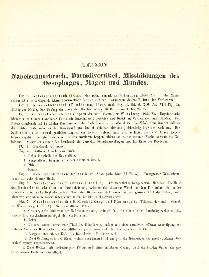 Nabelscliiiurbrucli, Barmdivertikel, Missbildungen des Oesophagus, Magen und Mundes. Fig. 1. Nabelschnurbruch (Präparat der path. Samml. zu Würzburg 1096. X). In der Nabel- schnur ist eine vorliegende kleine Darmschlinge deutlich sichtbar. Ausserdem defecte Bildung der Vorderarme. Fig. 2. Nabelschnurbruch (Thudichum, Illustr. med. Ztg. II. Bd. S. 216 Taf. VIII Fig. 2). Eintägiger Knabe, Der Umfang der Basis des Bruches betrug 16 Cm., seine Höhle 2i Cm. Fig. 3, 4. Nabelschnurbruch (Präparat der path. Samml. zu Würzburg 1082. X). Ungefähr acht Monate alter Meiner männlicher Fötus mit Encephalocelc posterior und Defect an Vorderarmen und Händen. Der Nabelschnurbruch hat 18 Linien Durchmesser, der Sack desselben ist sehr dünn, die Nabelschnur inserirt sich an der rechten Seite nahe an der Bauchwand und breitet sich von hier aus gleichmässig über den Sack aus. Der Sack enthält einen schmal gestielten Lappen der Leber, welcher halb dem rechten, halb dem linken Leber- lappen angehört und gleichsam einen dritten mittleren Lappen bildet; an seiner unteren Fläche verläuft die Na- belvene. Ausserdem enthält der Bruchsack ein Convolut Dünndarmschlingen und das Ende des Duodenum. Fig. 3. Bruchsack von aussen. Fig. 4. Seitliche Ansicht von innen. .. . _ a. Leber innerhalb der Bauchhöhle. . b. Vorgefallener Lappen, an einem schmalen Stiele. ~ .'::■' - c. Milz. , . • d. Magen. Fig. 5. Nabelschnurbruch (Cruveilhier, Anat. path. Livr. 31 PI. 5). Faustgrosser Nabelschnur- bruch mit sehr dünner Hülle. Fig. 6, Nabelschnurbruch (Cruveilhier 1. c). Achtmonatliches todtgeborenes Mädchen. Die Hülle des Bruchsackes ist sehr dünn und durchscheinend, zwischen der äusseren Wand und dem Peritonäum viel seröse Flüssigkeit; im Sacke liegt der grösste Theil des Dünn- und Dickdarmes und ein grosses Stück der Leber, wel- ches von der übrigen Leber durch einen tiefen Einschnitt abgegrenzt irar. Fig. 7. Nabelschnurbruch mit Kloakbildung und Blasenspalte (Präparat der path. Samml. zu Würzburg 1097. X). *° Sechsmonatlicher Fötus. a. Grosser, sehr dünnwandiger Nabclschnurbruch, welcher fast die sämmtlichen Baucheingeweide enthält, welche hier durchscheinend abgebildet worden sind, b. Leber, c. Unterer enorm erweiterter Theil des Dünndarms, endigt mit einer rundlichen offenen Ausstülpung am unteren Ende des Bruchsackes in der Mitte der gespaltenen und offen vorliegenden Harnblase. d. Vorgestülptes offenes Ende des Dünndarms. Dickdarm fehlt. e. Zwei Oeffnungen in der Blase, welche nach innen blind endigen, die Mündungen der geschwundenen Ge- schlechtsgänge repräsentirend. f. Zwei Höcker mit kreisförmigen Falten und einer mittleren Grube, wohl die blinden Ostien der ge- schwundenen Ureteren darstellend, , , ir-