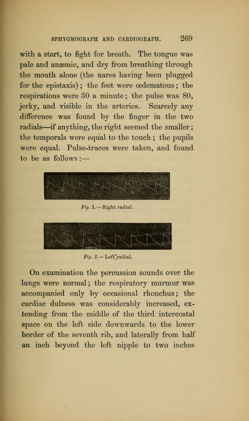 with a start, to fight for breath. The tongue was pale and anaemic, and dry from breathing through the mouth alone (the nares having been plugged for the epistaxis) ; the feet were cedematous; the respirations were 30 a minute; the pulse was 80, jerky, and visible in the arteries. Scarcely any difference was found by the finger in the two radials—if anything, the right seemed the smaller; the temporals were equal to the touch ; the pupils were equal. Pulse-traces were taken, and found to be as follows :— Fig. 1.— Right radial. Fig. 2.— Leftf/adial. On examination the percussion sounds over the lungs were normal; the respiratory murmur was accompanied only by occasional rhonchus; the cardiac dulness was considerably increased, ex- tending from the middle of the third intercostal space on the left side downwards to the lower border of the seventh rib, and laterally from half an inch beyond the left nipple to two inches