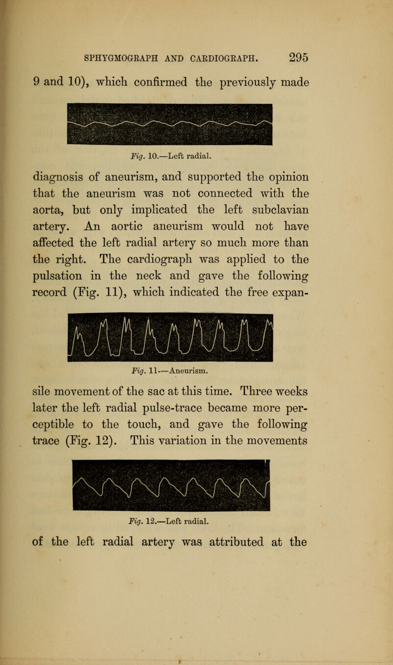 9 and 10), which confirmed the previously made Fig. 10.—Left radial. diagnosis of aneurism, and supported the opinion that the aneurism was not connected with the aorta, but only implicated the left subclavian artery. An aortic aneurism would not have affected the left radial artery so much more than the right. The cardiograph was applied to the pulsation in the neck and gave the following record (Fig. 11), which indicated the free expan- iiiiiiiffl Fig. 11—Aneurism. sile movement of the sac at this time. Three weeks later the left radial pulse-trace became more per- ceptible to the touch, and gave the following trace (Kg. 12). This variation in the movements Fig. 12.—Left radial. of the left radial artery was attributed at the