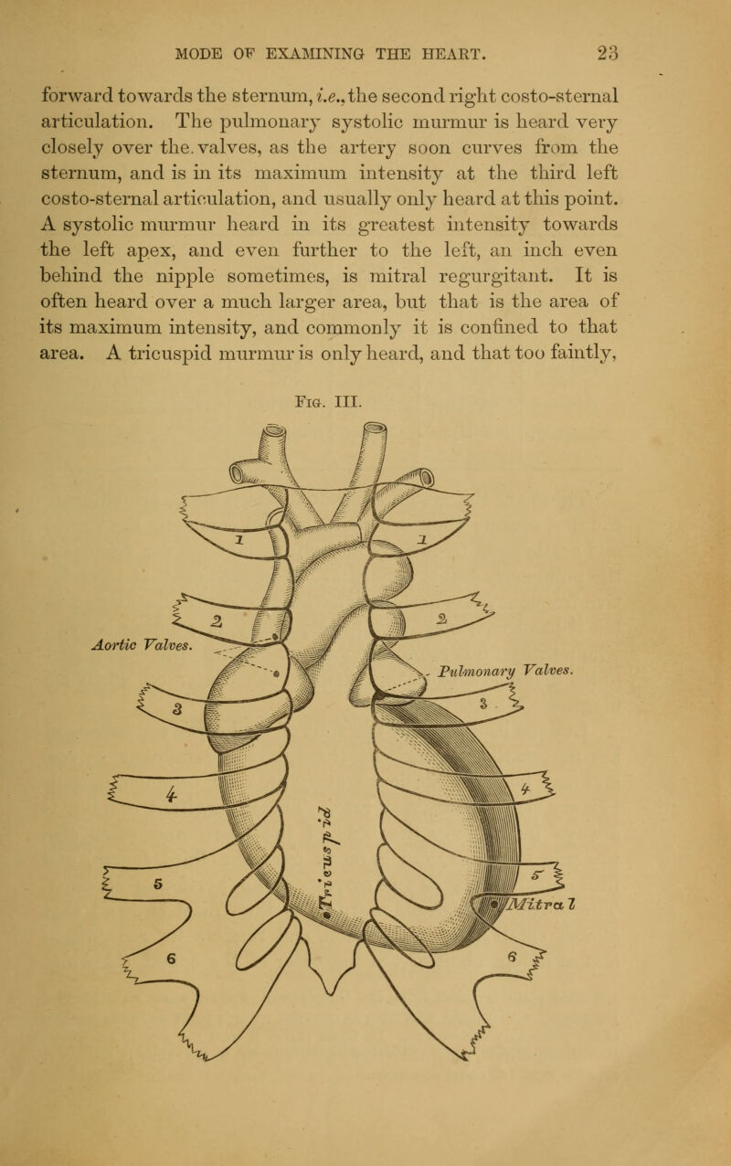 forward towards the sternum, {.^..tlie second right costo-sternal articulation. The pulmonary systolic murmur is heard very closely over the. valves, as the artery soon curves from the sternum, and is in its maximum intensity at the third left costo-sternal articulation, and usually only heard at this point. A systolic murmur heard in its greatest intensity towards the left apex, and even further to the left, an inch even behind the nipple sometimes, is mitral regurgitant. It is often heard over a much larger area, but that is the area of its maximum intensity, and commonly it is conhned to that area. A tricuspid murmur is only heard, and that too faintly, Fia. III. Aortic Valves Pulmonary Valves.