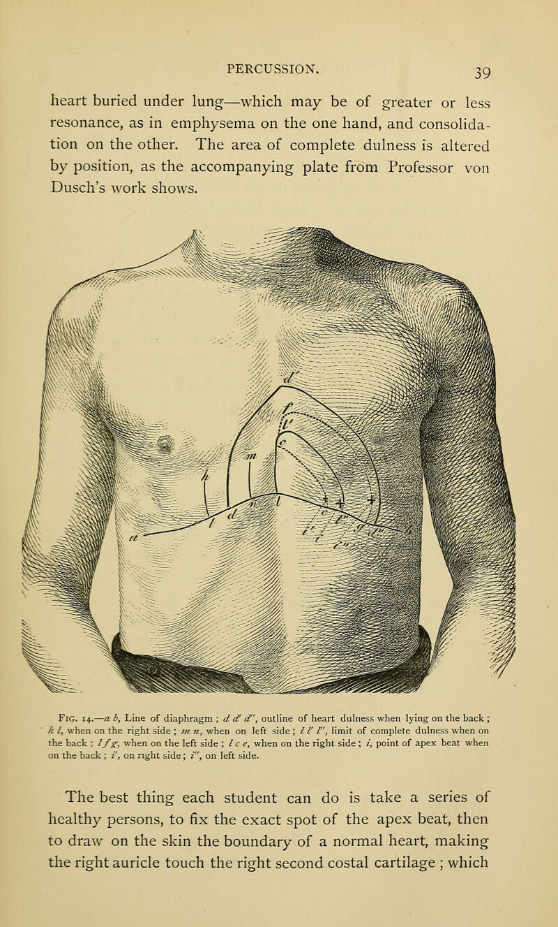 PERCUSSION. heart buried under lung which may be of greater or less resonance, as in emphysema on the one hand, and consolida- tion on the other. The area of complete dulness is altered by position, as the accompanying plate from Professor von Dusch's work shows. Fig. 14.—a b, Line of diaphragm ; d d' d, outline of heart dulness when lying on the back ; h I, when on the right side ; »z n, when on left side ; /1' I, limit of complete dulness when on the back ; Ifg, when on the left side ; I c e, when on the right side ; i, point of apex beat when on the back ; i', on right side; i, on left side. The best thing each student can do is take a series of healthy persons, to fix the exact spot of the apex beat, then to draw on the skin the boundary of a normal heart, making the right auricle touch the right second costal cartilage ; which