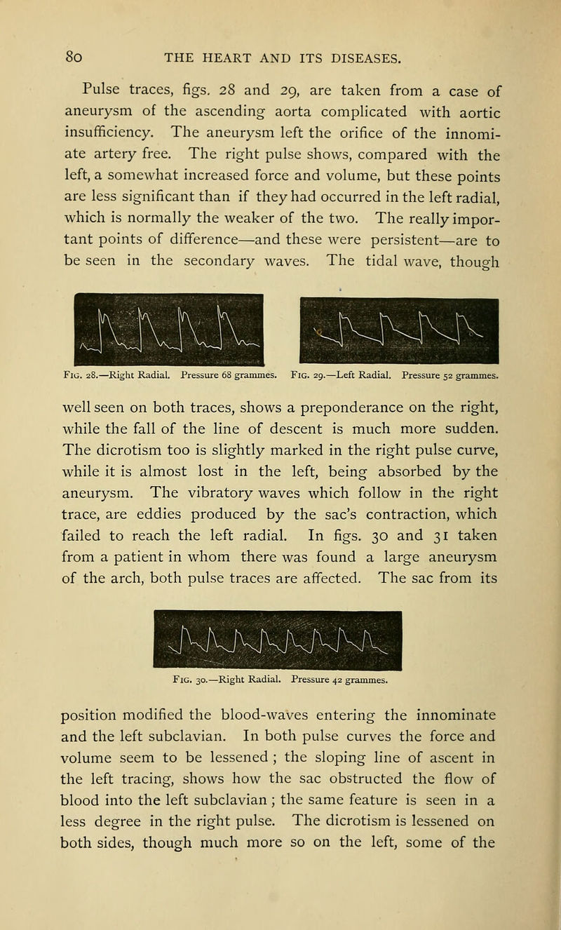 Pulse traces, figs. 28 and 29, are taken from a case of aneurysm of the ascending- aorta complicated with aortic insufficiency. The aneurysm left the orifice of the innomi- ate artery free. The right pulse shows, compared with the left, a somewhat increased force and volume, but these points are less significant than if they had occurred in the left radial, which is normally the weaker of the two. The really impor- tant points of difference—and these were persistent—are to be seen in the secondary waves. The tidal wave, though Fig. 28.—Right Radial. Pressure 68 grammes. Fig. 29.—Left Radial. Pressure 52 grammes. well seen on both traces, shows a preponderance on the right, while the fall of the line of descent is much more sudden. The dicrotism too is slightly marked in the right pulse curve, while it is almost lost in the left, being absorbed by the aneurysm. The vibratory waves which follow in the right trace, are eddies produced by the sac's contraction, which failed to reach the left radial. In figs. 30 and 31 taken from a patient in whom there was found a large aneurysm of the arch, both pulse traces are affected. The sac from its Fig. 30.—Right Radial. Pressure 42 grammes. position modified the blood-waves entering the innominate and the left subclavian. In both pulse curves the force and volume seem to be lessened ; the sloping line of ascent in the left tracing, shows how the sac obstructed the flow of blood into the left subclavian; the same feature is seen in a less degree in the right pulse. The dicrotism is lessened on both sides, though much more so on the left, some of the