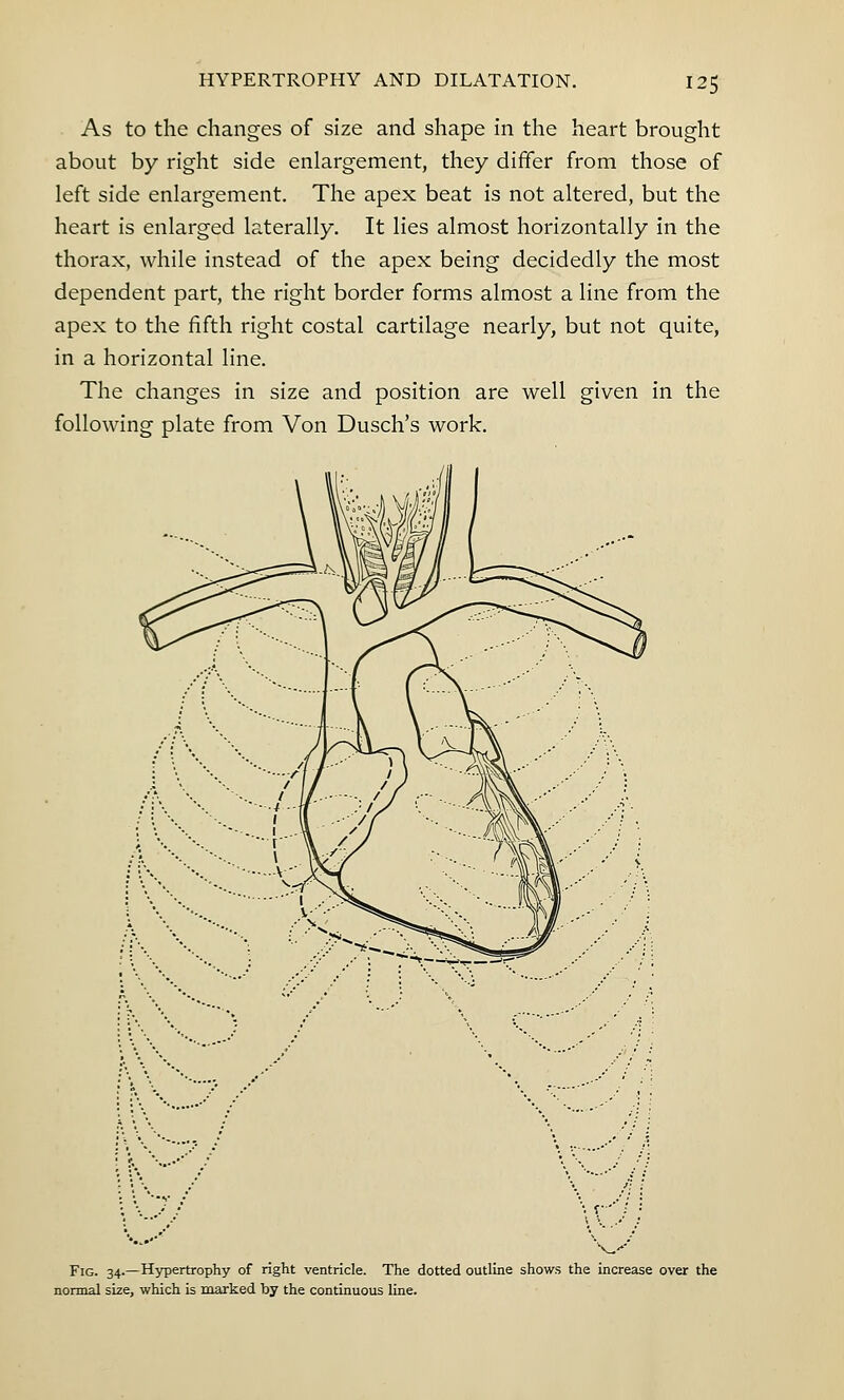 As to the changes of size and shape in the heart brought about by right side enlargement, they differ from those of left side enlargement. The apex beat is not altered, but the heart is enlarged laterally. It lies almost horizontally in the thorax, while instead of the apex being decidedly the most dependent part, the right border forms almost a line from the apex to the fifth right costal cartilage nearly, but not quite, in a horizontal line. The changes in size and position are well given in the following plate from Von Dusch's work. Fig. 34.—Hypertrophy of right ventricle. The dotted outline shows the increase over the normal size, which is marked by the continuous line.