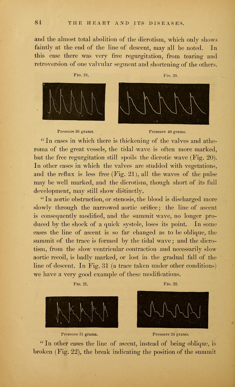 and the almost total abolition of the dicrotism, which only shows faintly at the end of the line of descent, may all be noted. In this case there was very free regurgitation, from tearing and retroversion of one valvular segment and shortening of the others. Fig. 19. Fir. 20. Pressure 36 grams. Pressure 40 grams. In cases in which there is thickening of the valves and athe- roma of the great vessels, the tidal wave is often more marked, but the free regurgitation still spoils the dicrotic wave (Fig. 20). In other cases in which the valves are studded with vegetations, and the reflux is less free (Fig. 21), all the waves of the pulse may be well marked, and the dicrotism, though short of its full development, may still show distinctly. In aortic obstruction, or stenosis, the blood is discharged more slowly through the narrowed aortic orifice; the line of ascent is consequently modified, and the summit wave, no longer pro- duced by the shock of a quick systole, loses its point. In some cases the line of ascent is so far changed as to be oblique, the summit of the trace is formed by the tidal wave; and the dicro- tism, from the slow ventricular contraction and necessarily slow aortic recoil, is badly marked, or lost in the gradual fall of the line of descent. In Fig. 31 (a trace taken under other conditions) we have a very good example of these modifications. Fig. 21. Fig. 22. Pressure 51 grams. Pressure 24 grams.  In other cases the line of ascent, instead of being oblique, is broken (Fig. 22), the break indicating the position of the summit